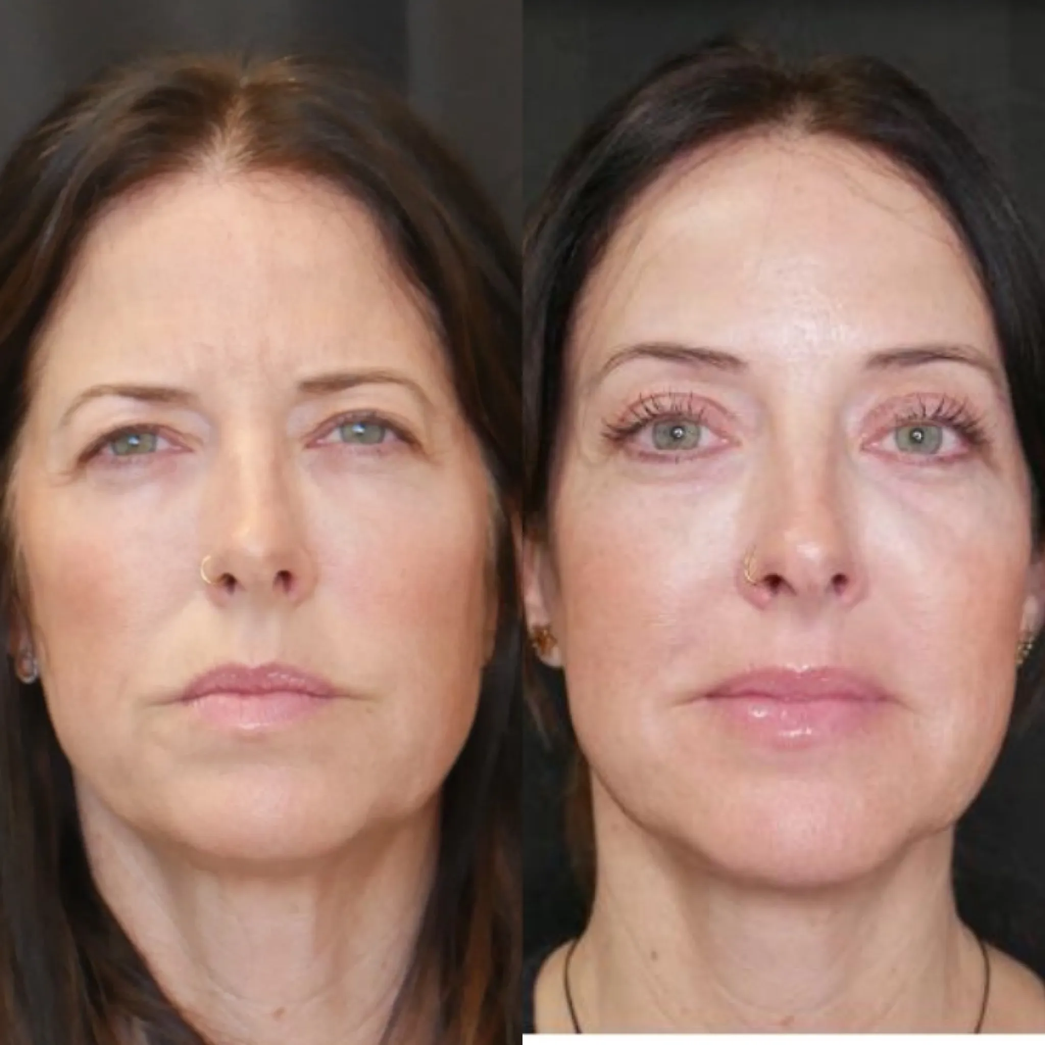 Upper Blepharoplasty & Endo Brow, before and after, patient of Dr. Christine Bokman