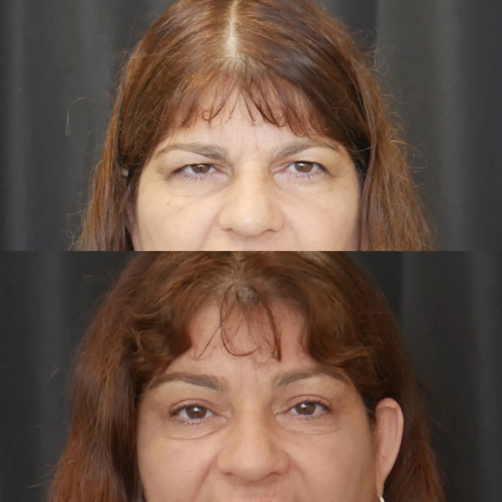 Upper Blepharoplasty & Endo Brow, before and after, patient of Dr. Christine Bokman