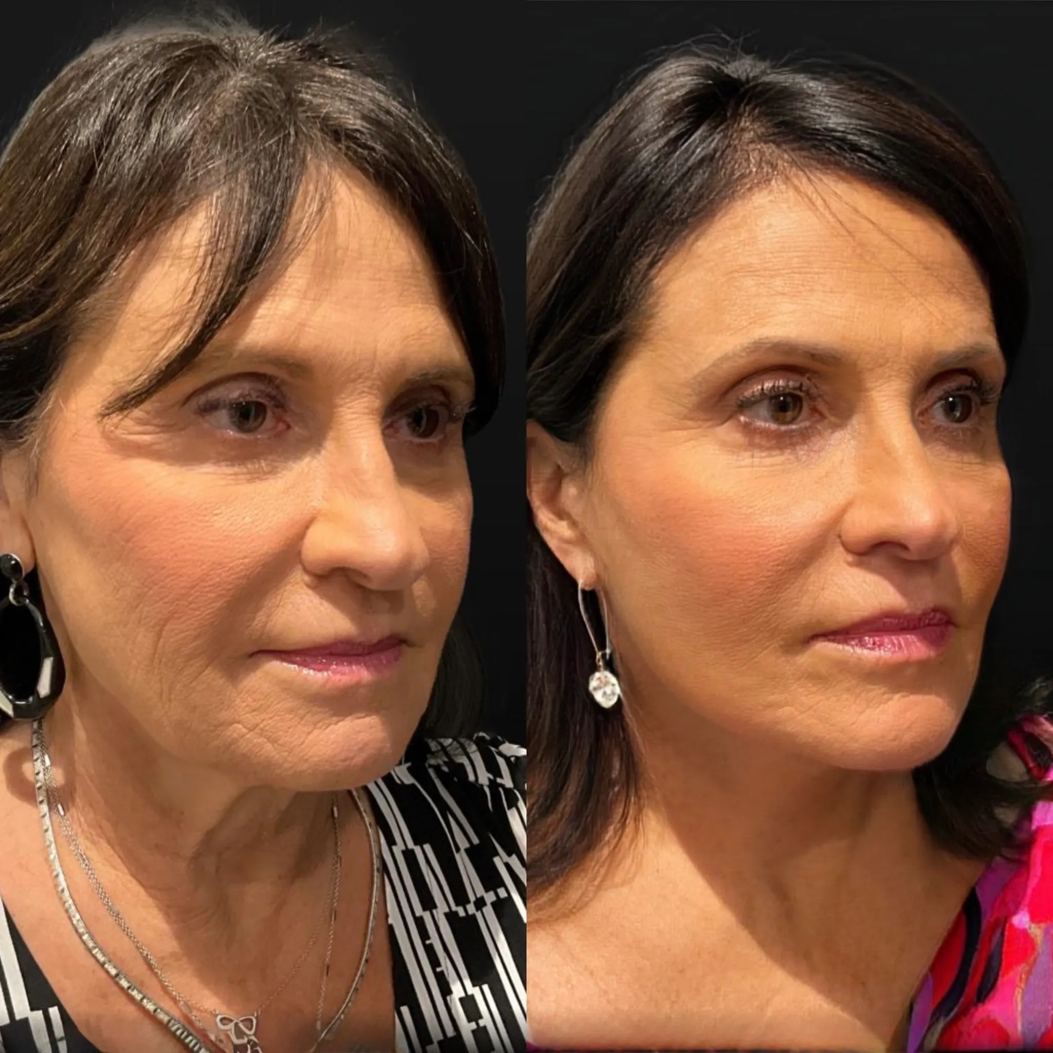 Face & Neck Lift, before and after, patient of Dr. Christine Bokman