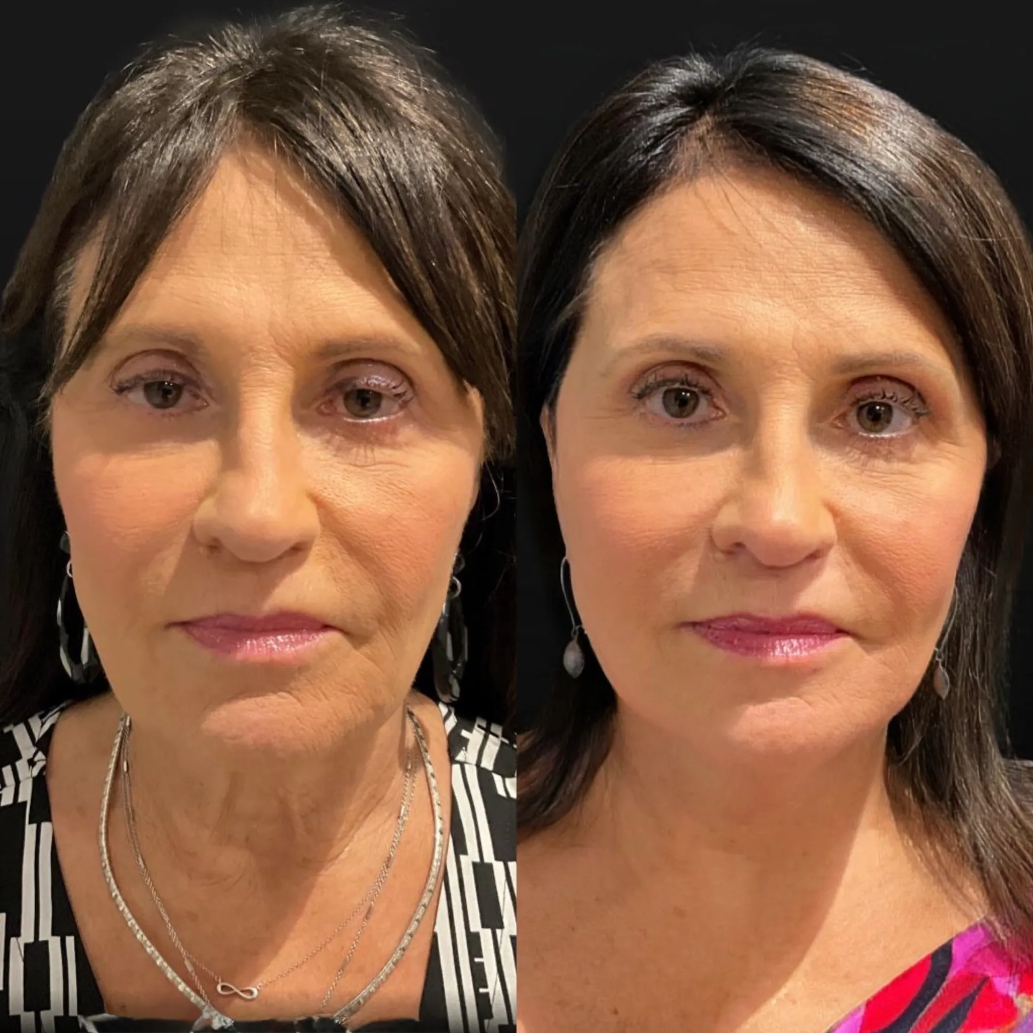 Face & Neck Lift, before and after, patient of Dr. Christine Bokman