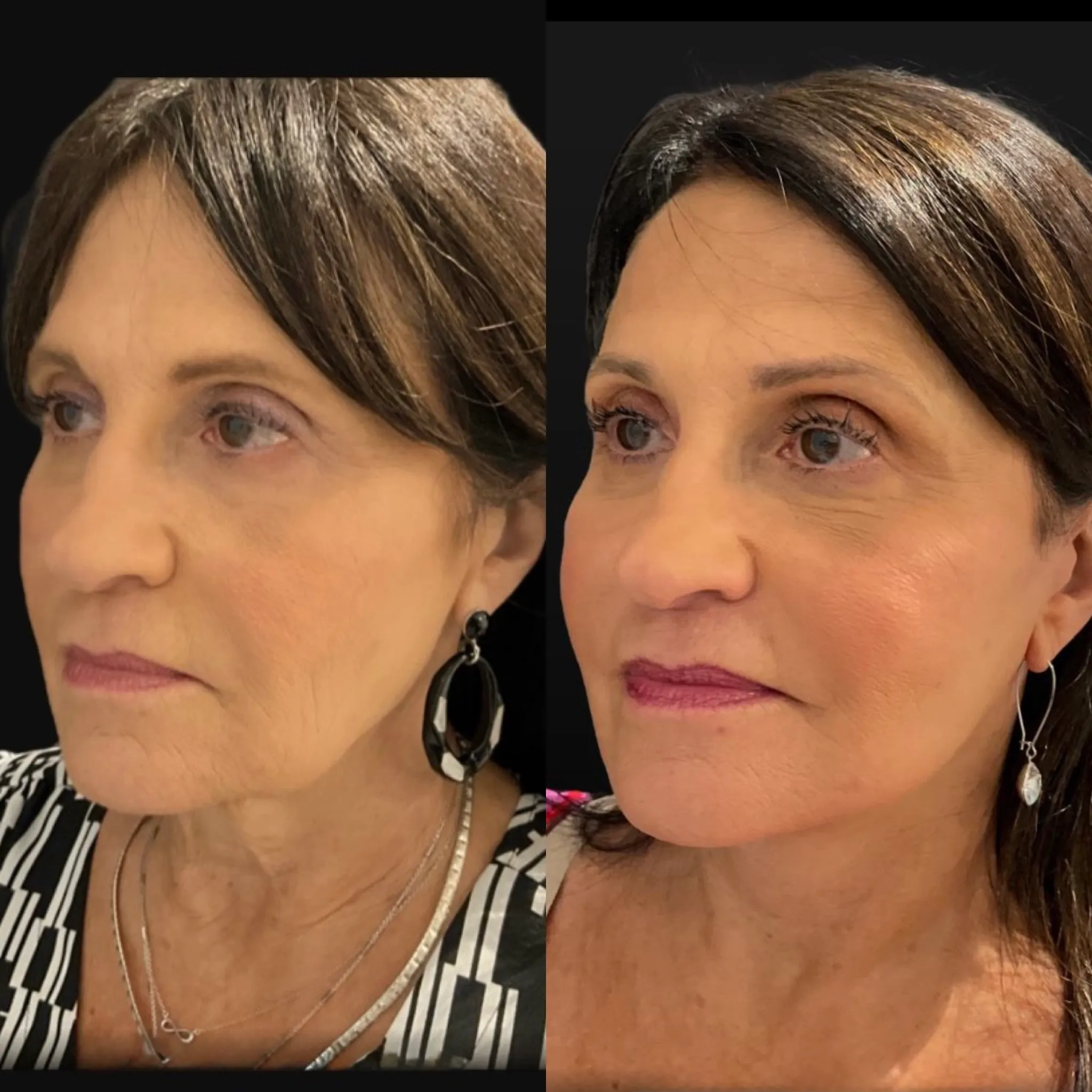 Face & Neck Lift, before and after, patient of Dr. Christine Bokman