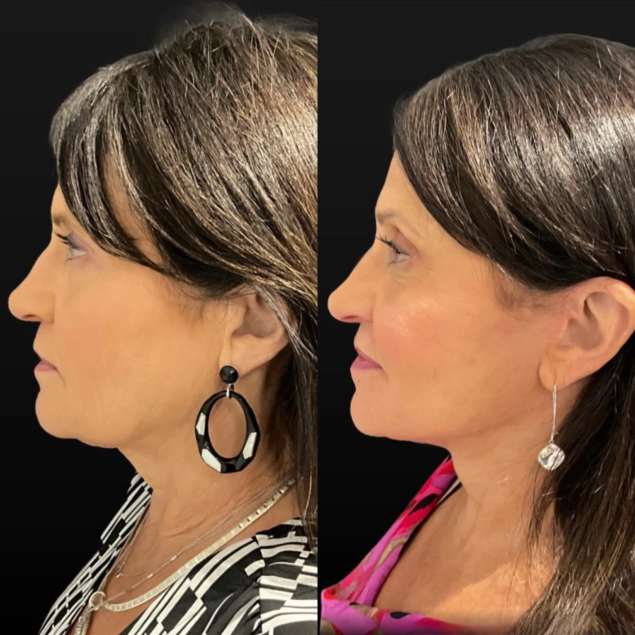 Face & Neck Lift, before and after, patient of Dr. Christine Bokman