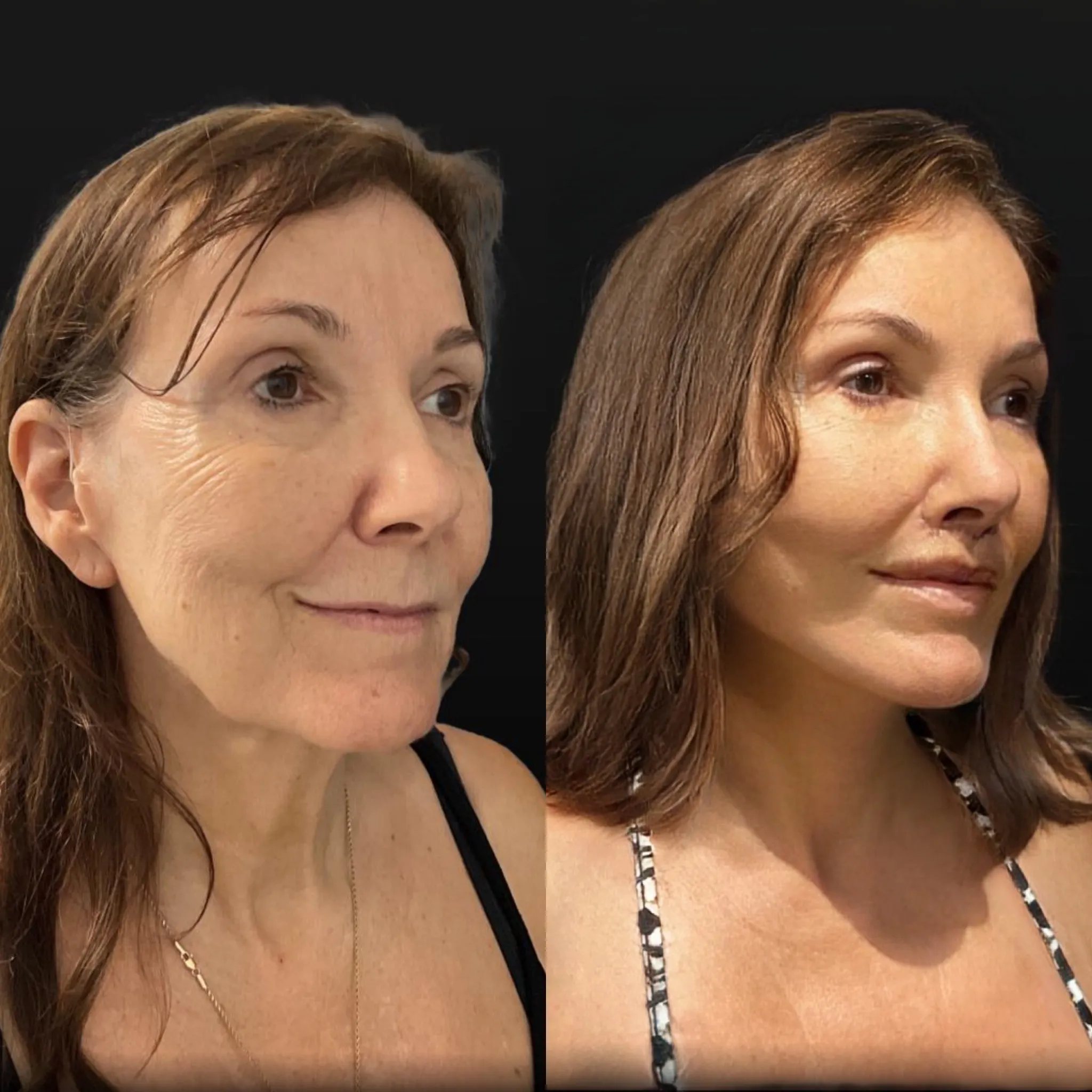 Face & Neck Lift, before and after, patient of Dr. Christine Bokman