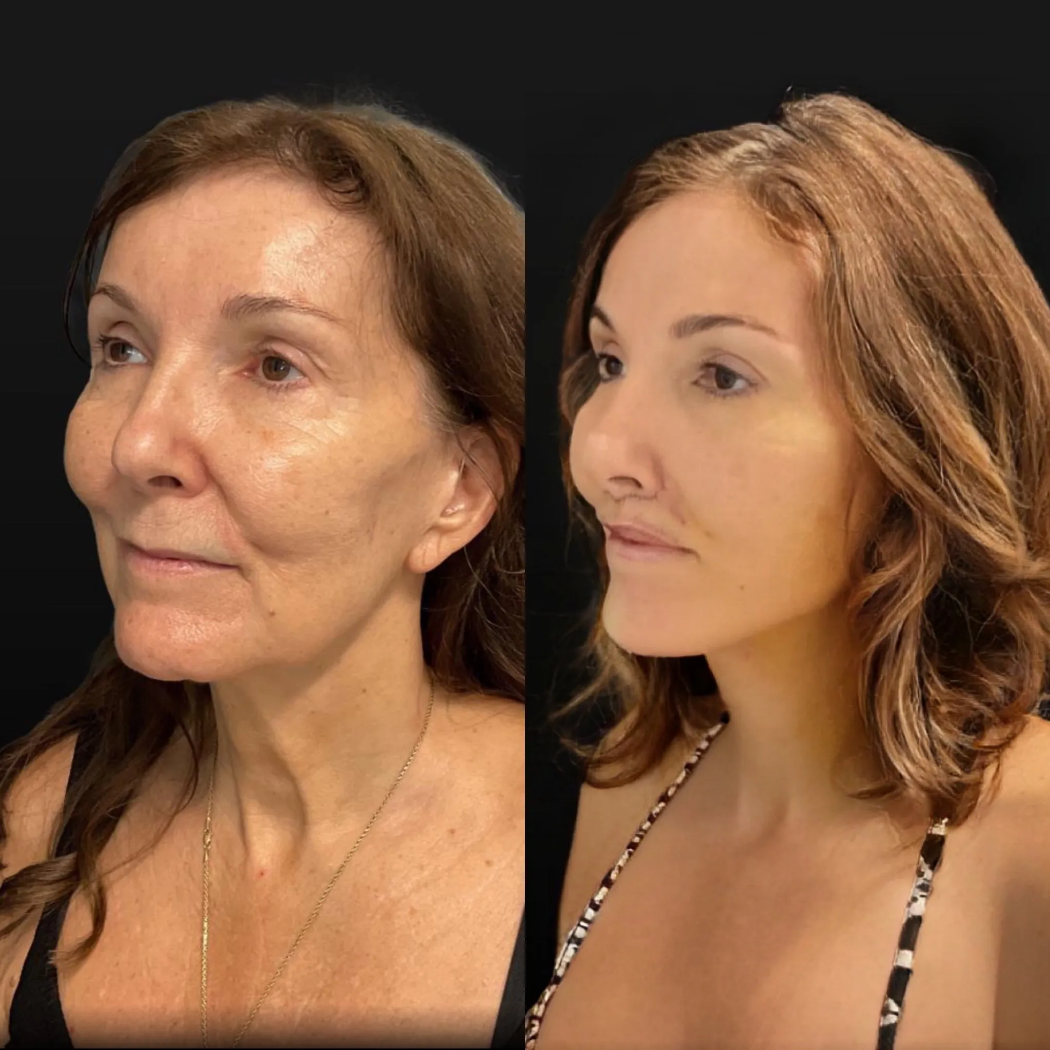 Face & Neck Lift, before and after, patient of Dr. Christine Bokman