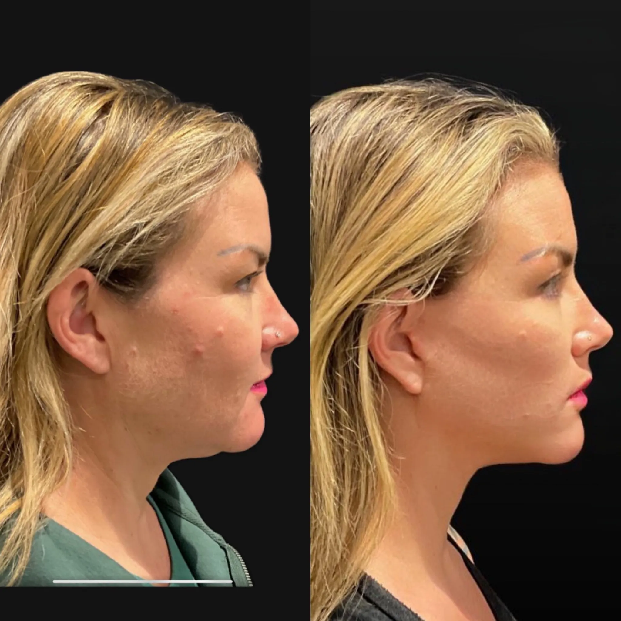 Face & Neck Lift, before and after, patient of Dr. Christine Bokman