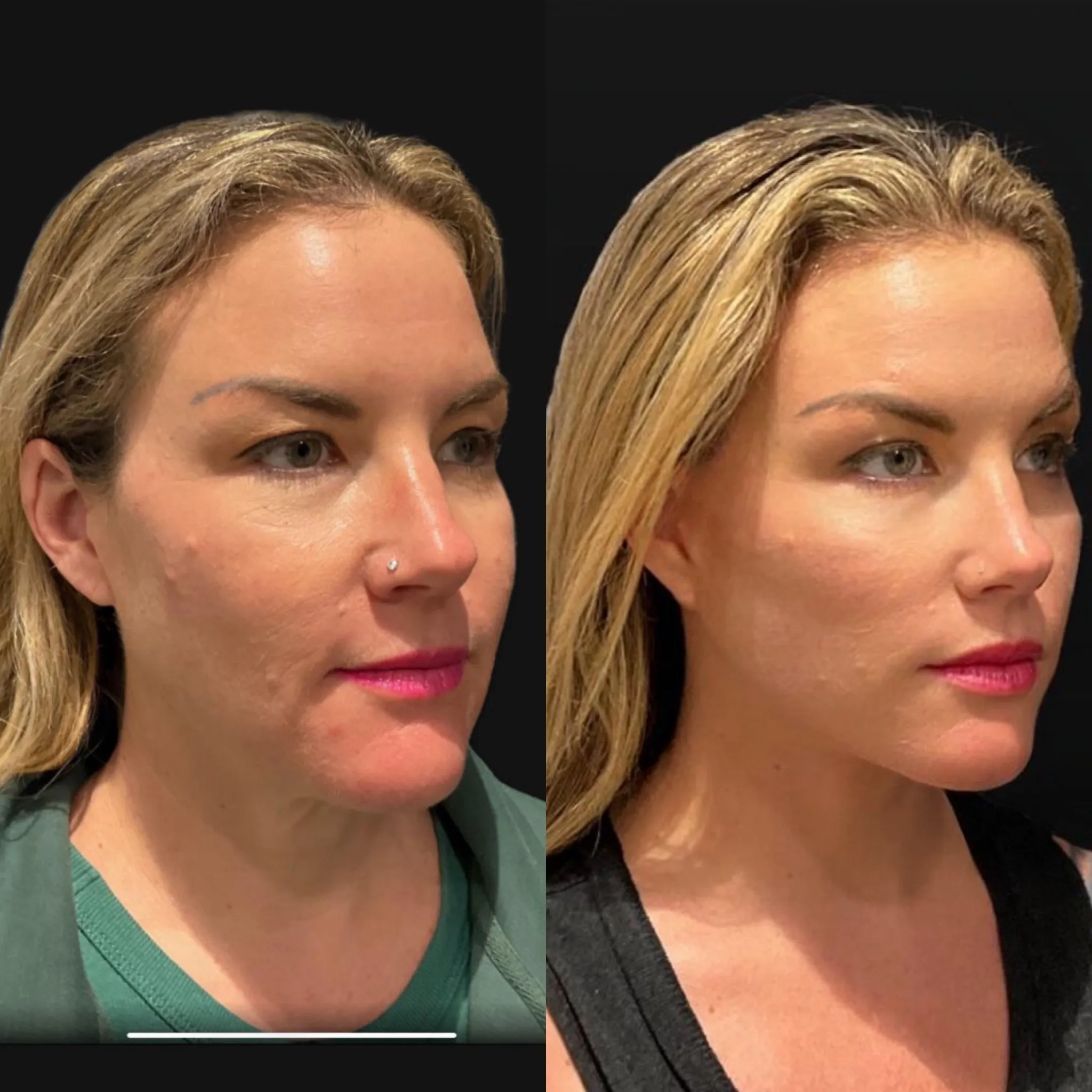 Face and neck lift, before and after, patient of Dr. Christine Bokman