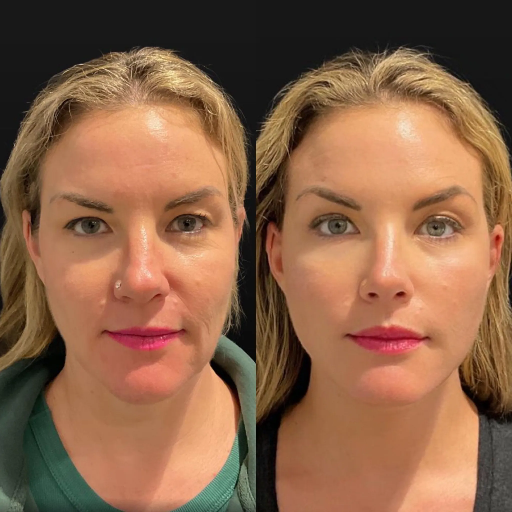 Face & Neck Lift, before and after, patient of Dr. Christine Bokman