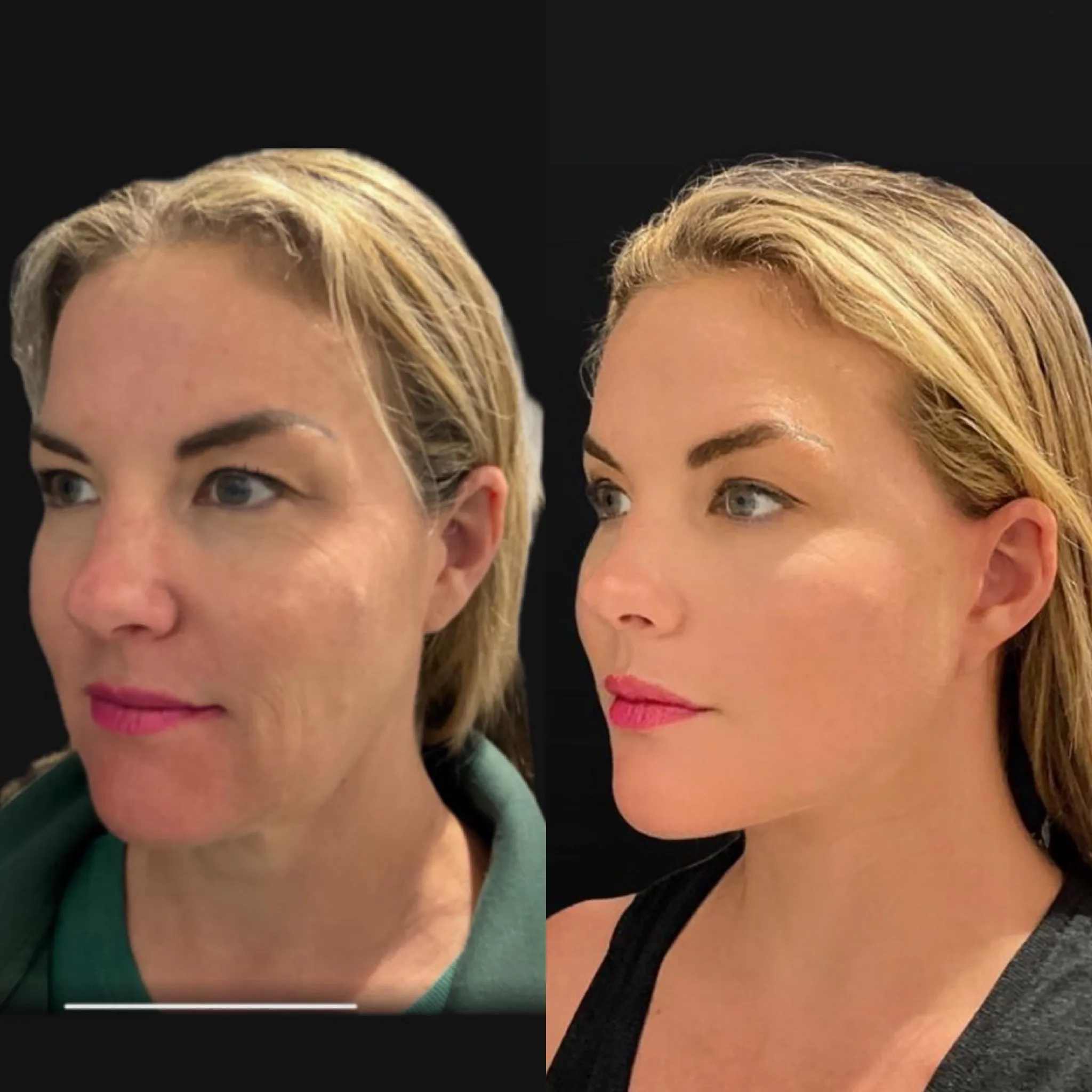 Face & Neck Lift, before and after, patient of Dr. Christine Bokman