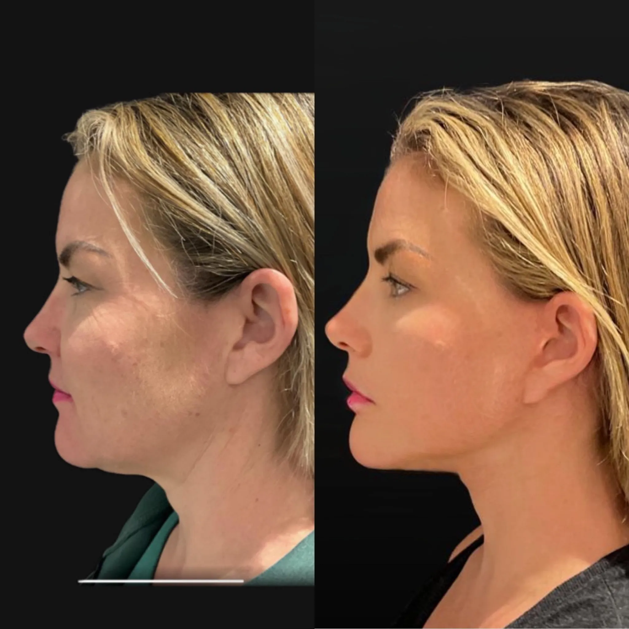 Face & Neck Lift, before and after, patient of Dr. Christine Bokman