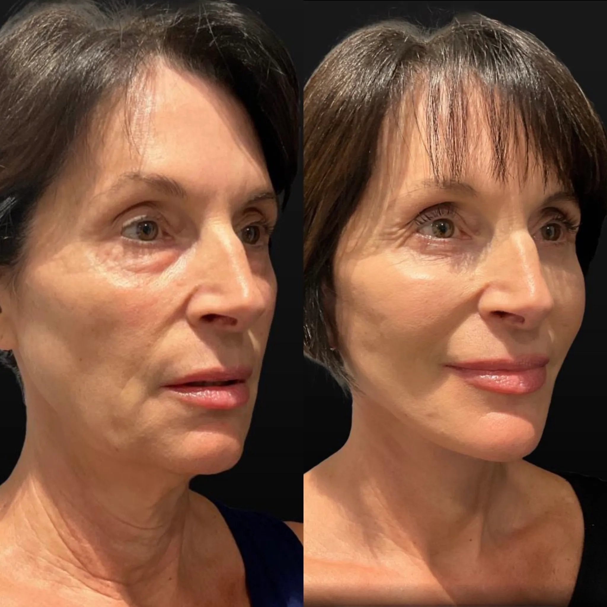 Facelift Neck Lift & Lower Blepharoplasty, before and after, patient of Dr. Christine Bokman