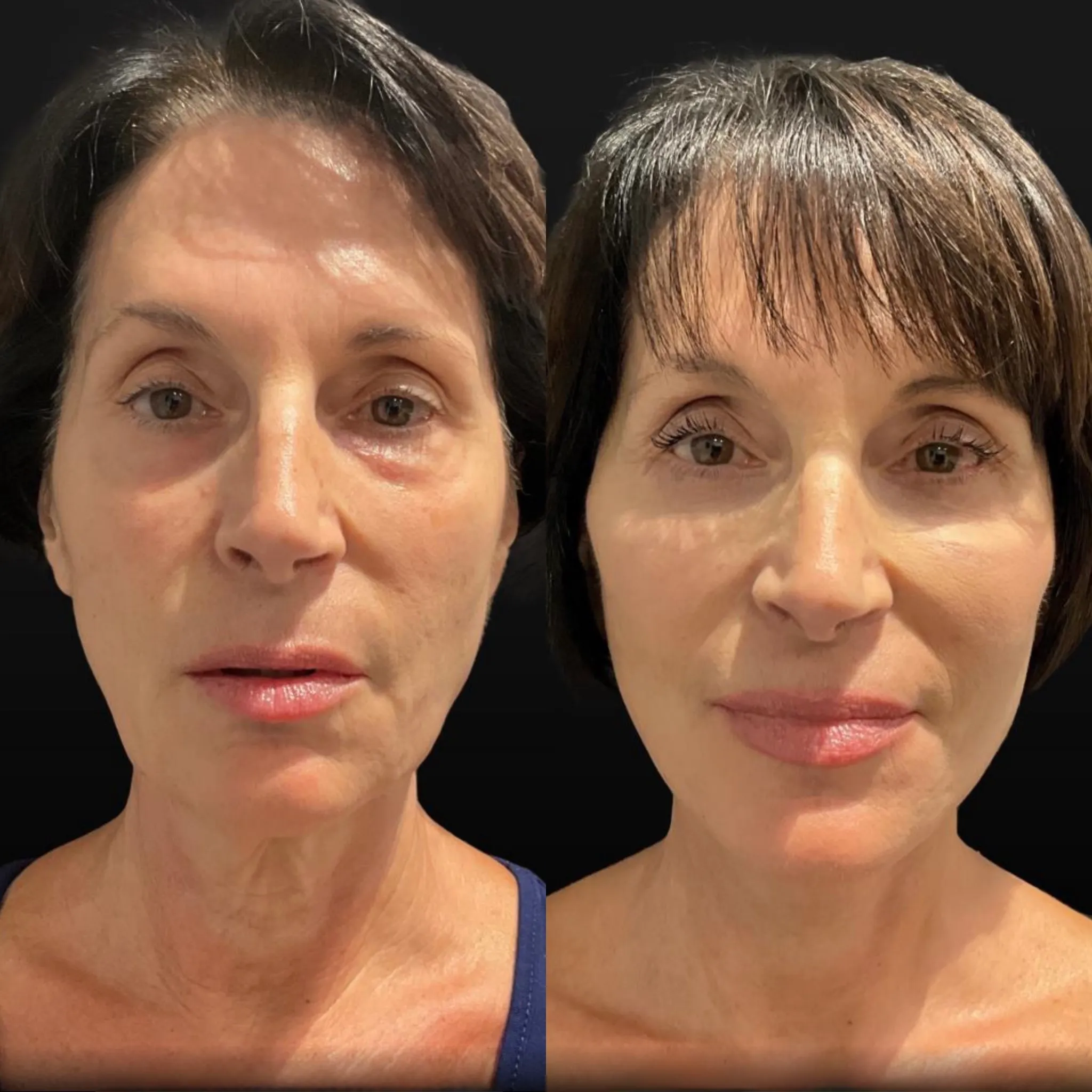 Facelift Neck Lift & Lower Blepharoplasty, before and after, patient of Dr. Christine Bokman