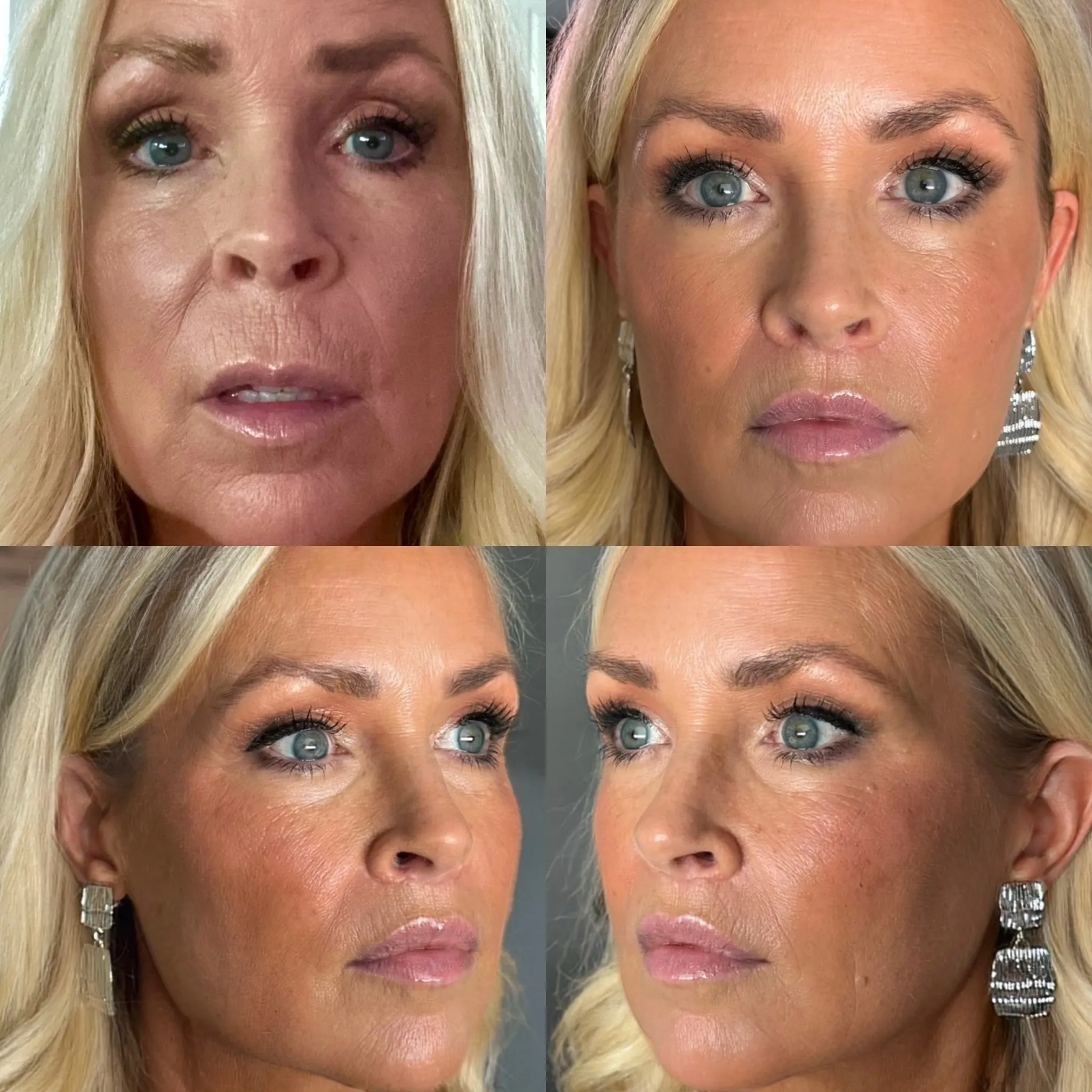 Lip Lift, before and after, patient of Dr. Christine Bokman