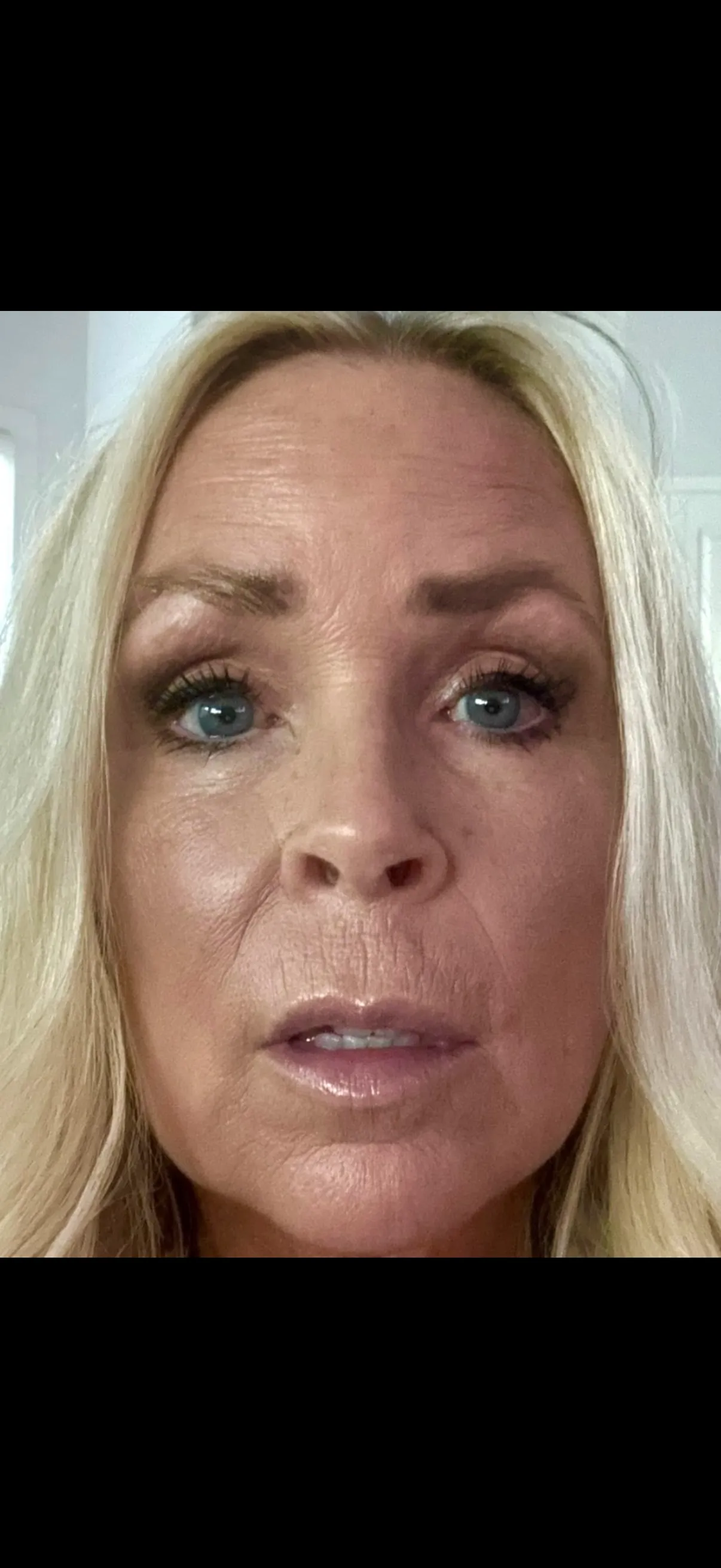 Lip Lift, before and after, patient of Dr. Christine Bokman