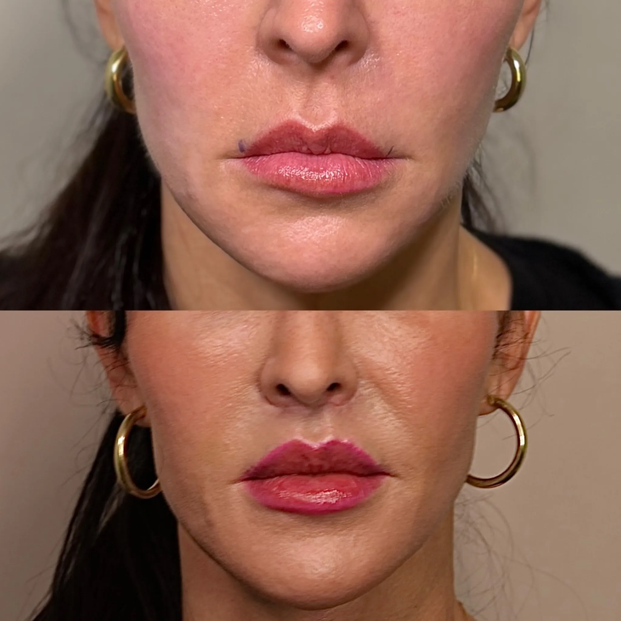 Lip Lift, before and after, patient of Dr. Christine Bokman
