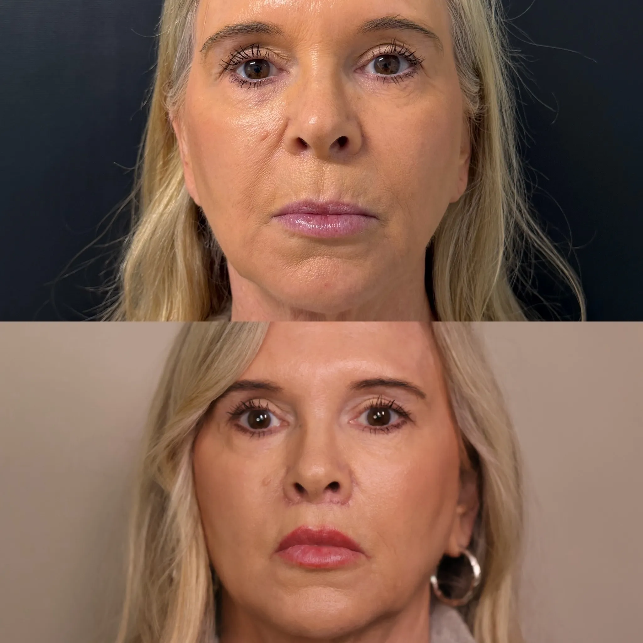 Lip Lift, before and after, patient of Dr. Christine Bokman