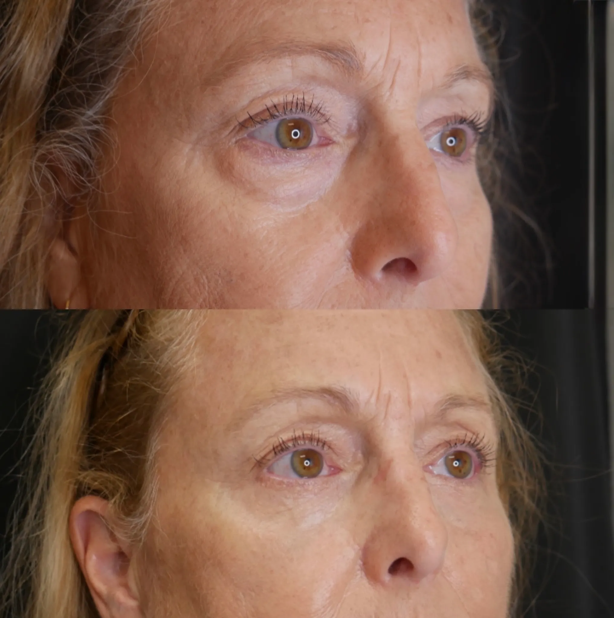 Lower Blepharoplasty, before and after, patient of Dr. Christine Bokman