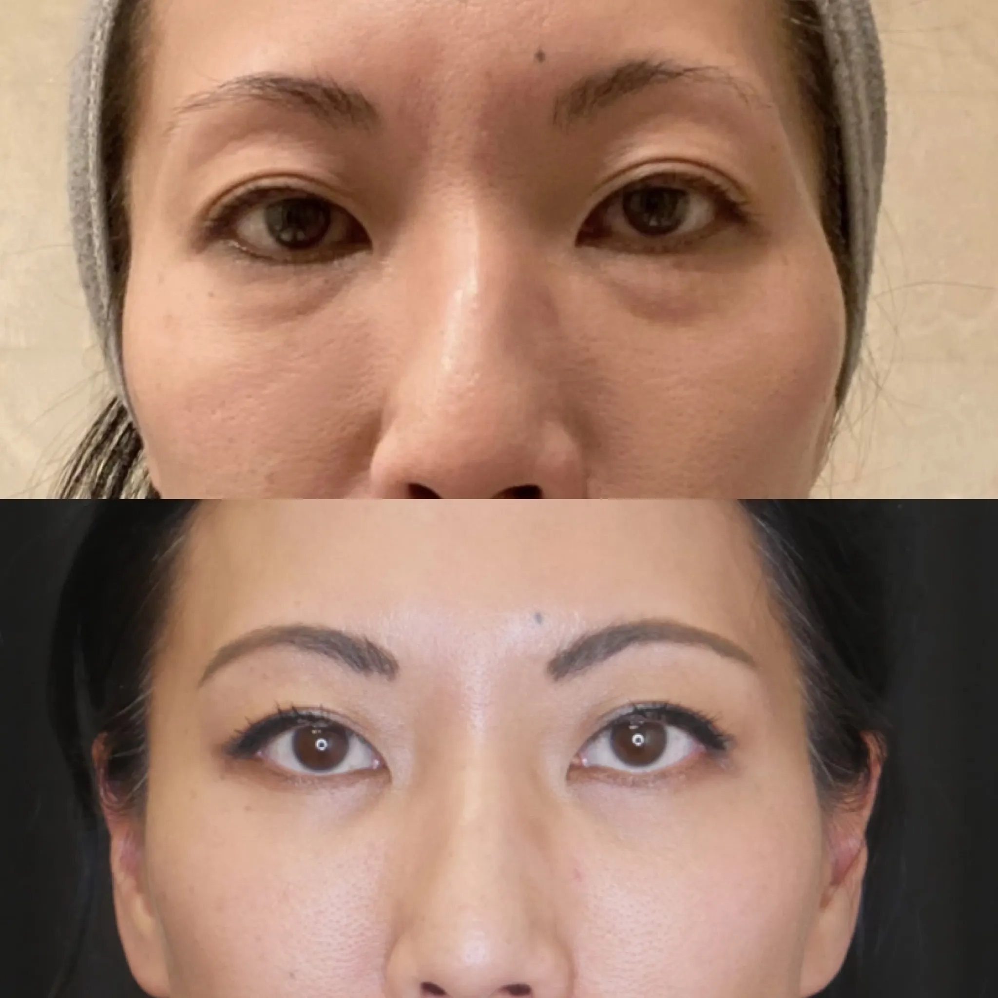Lower Blepharoplasty, before and after, patient of Dr. Christine Bokman