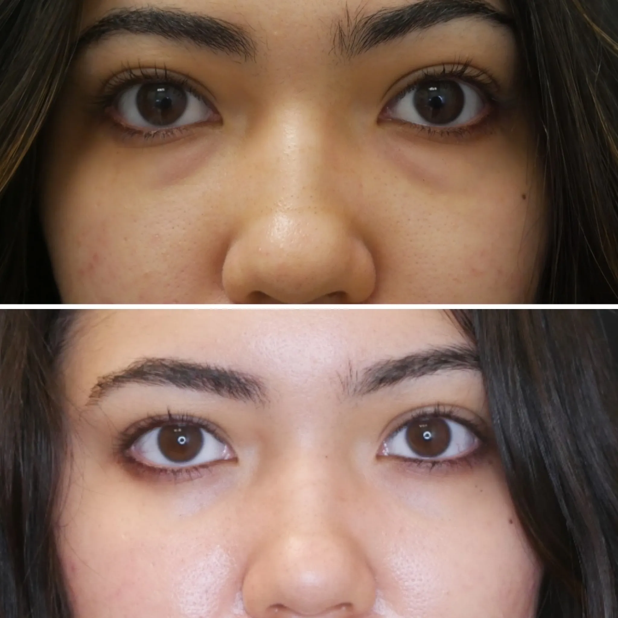Lower Blepharoplasty, before and after, patient of Dr. Christine Bokman