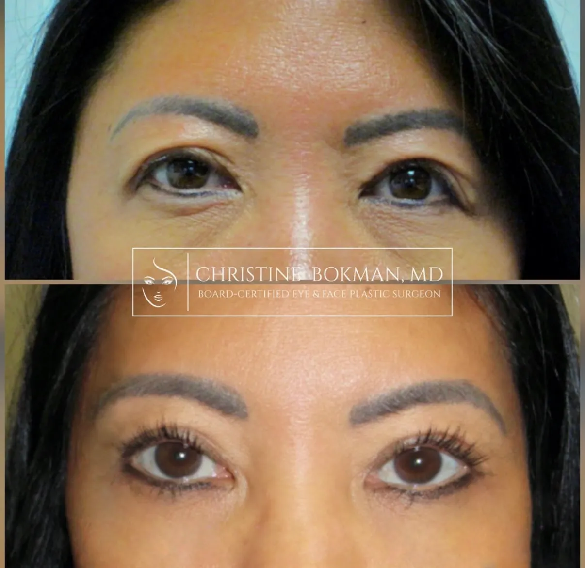 Lower Blepharoplasty, before and after, patient of Dr. Christine Bokman