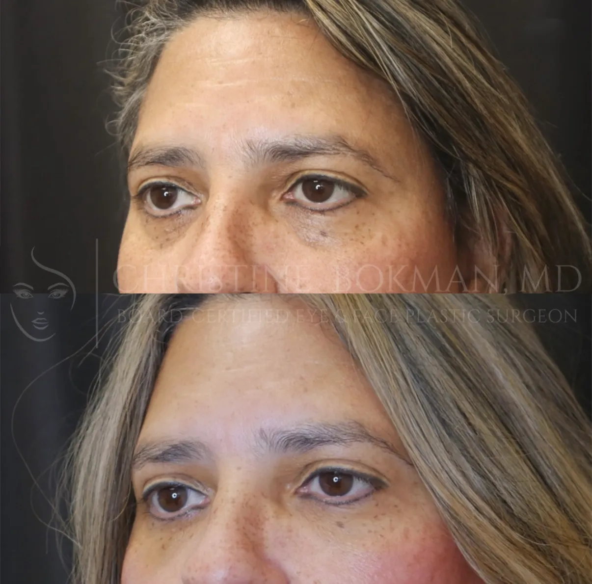 Lower Eyelid Filler, before and after, patient of Dr. Christine Bokman