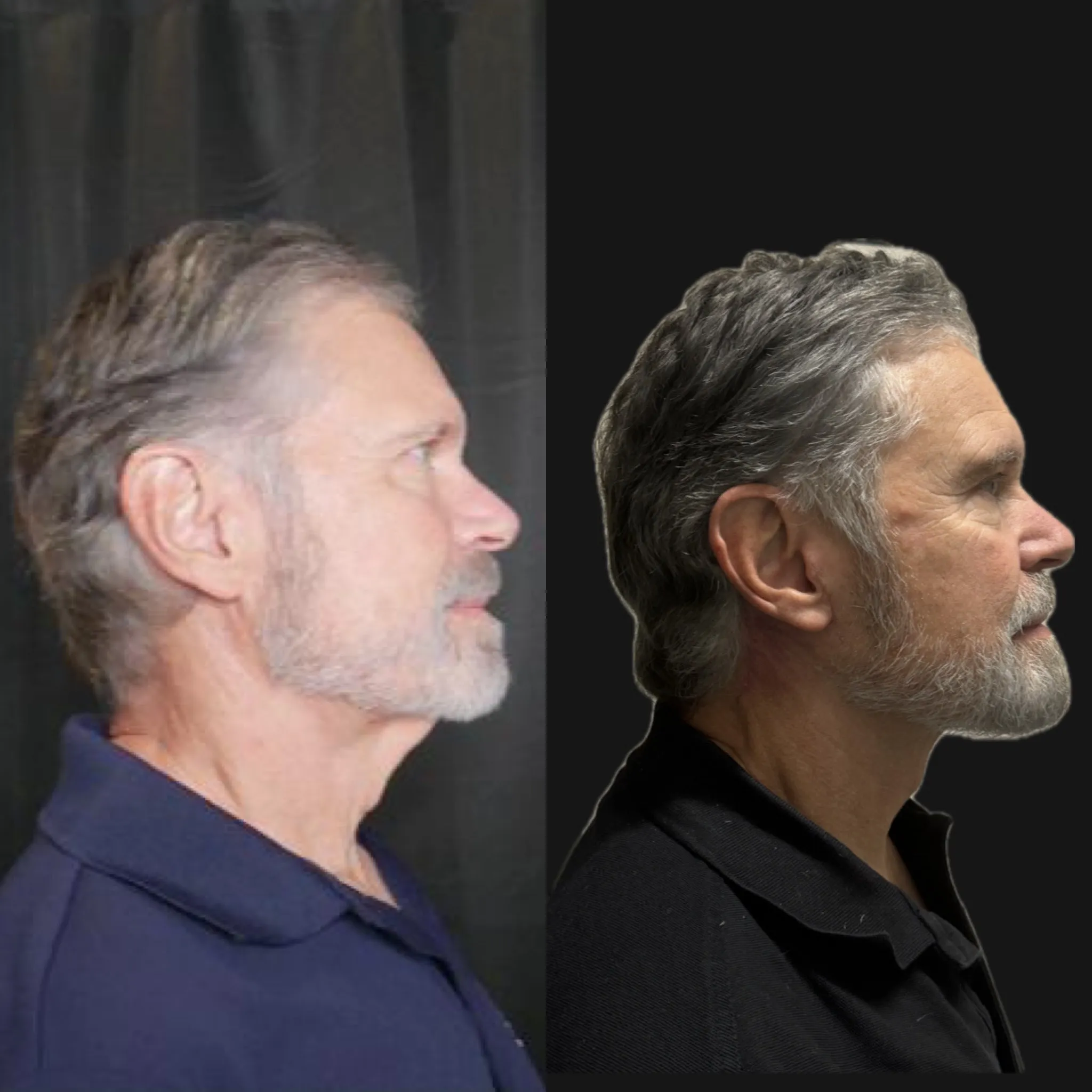 Male Face & Neck Lift, before and after, patient of Dr. Christine Bokman