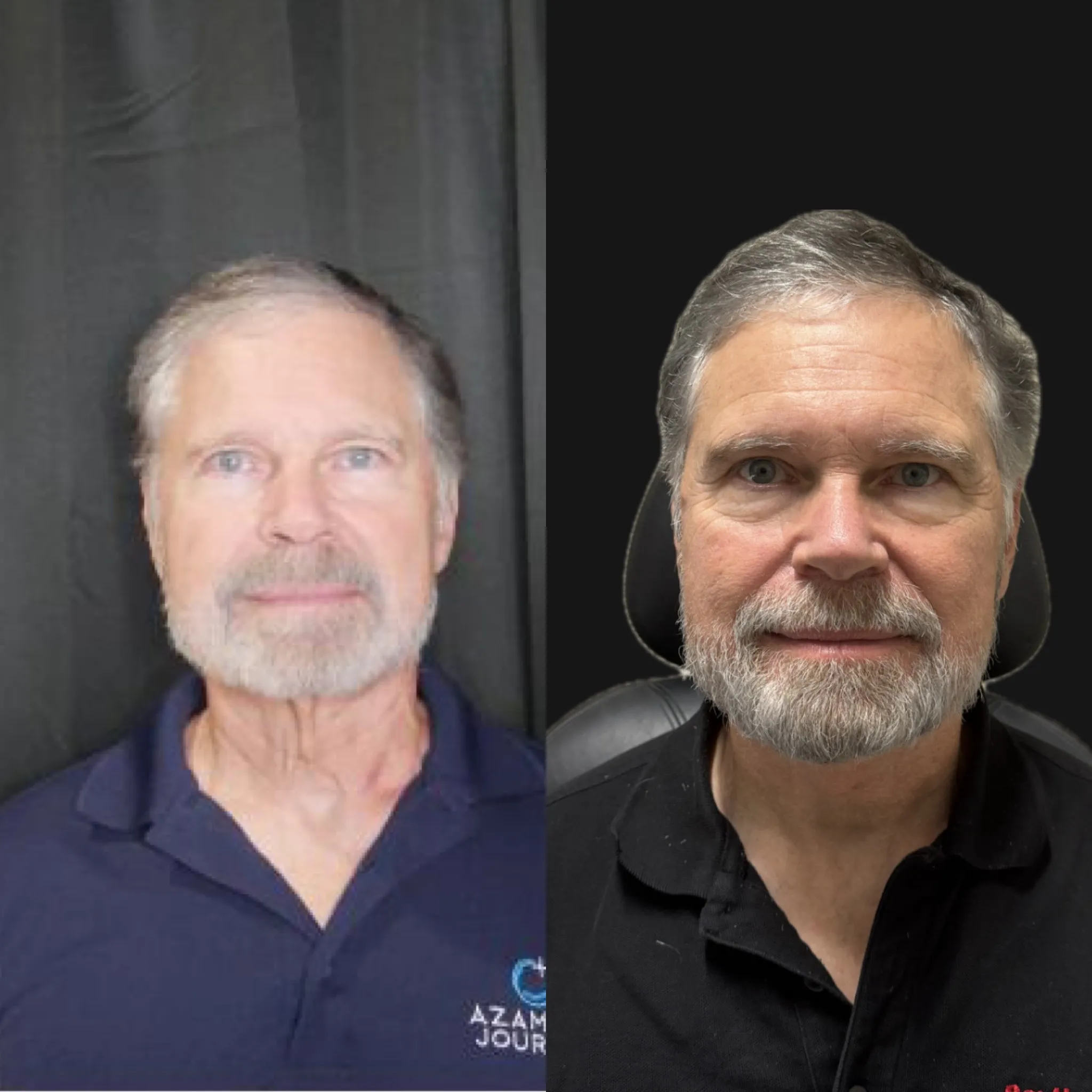 Male Face & Neck Lift, before and after, patient of Dr. Christine Bokman