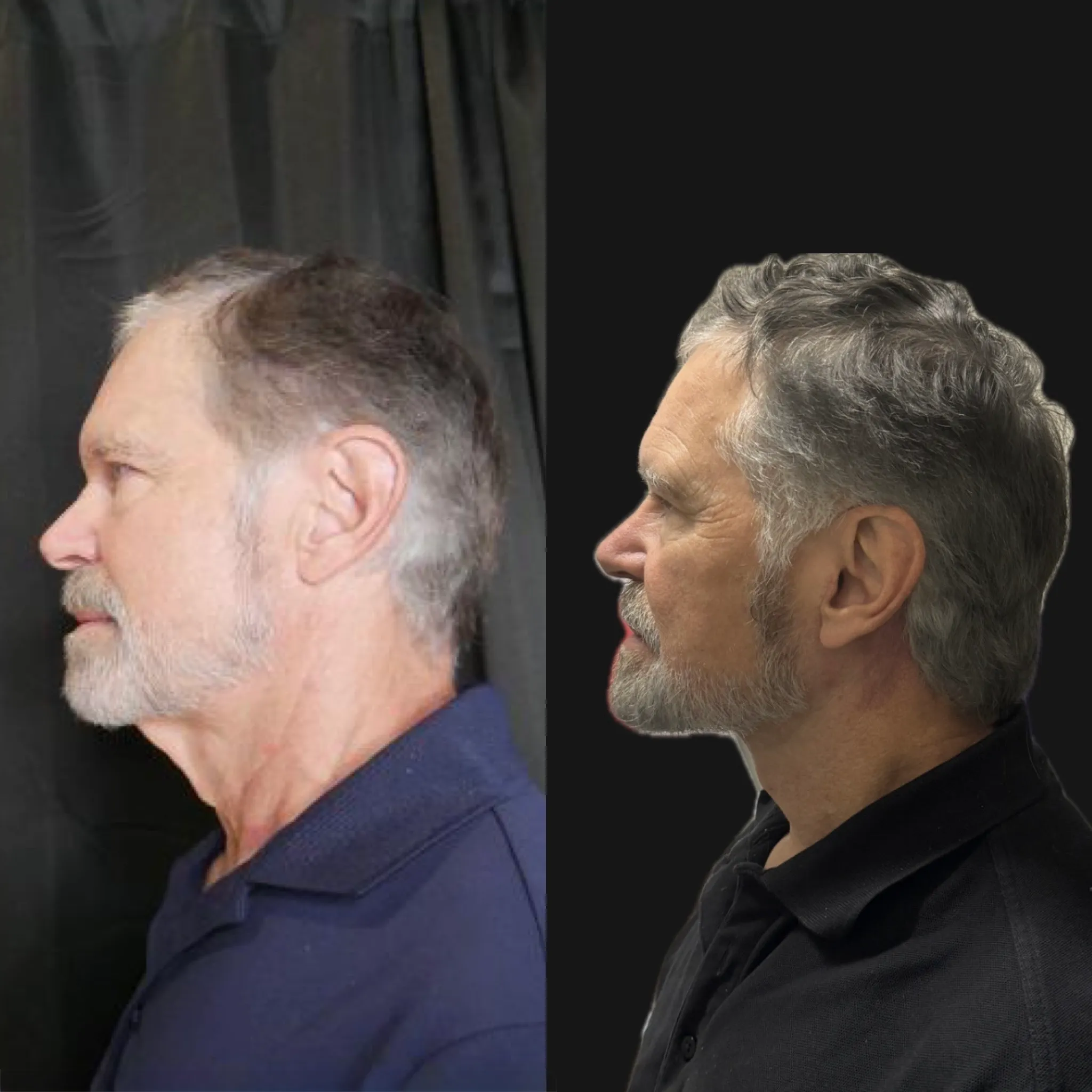 Male Face & Neck Lift, before and after, patient of Dr. Christine Bokman