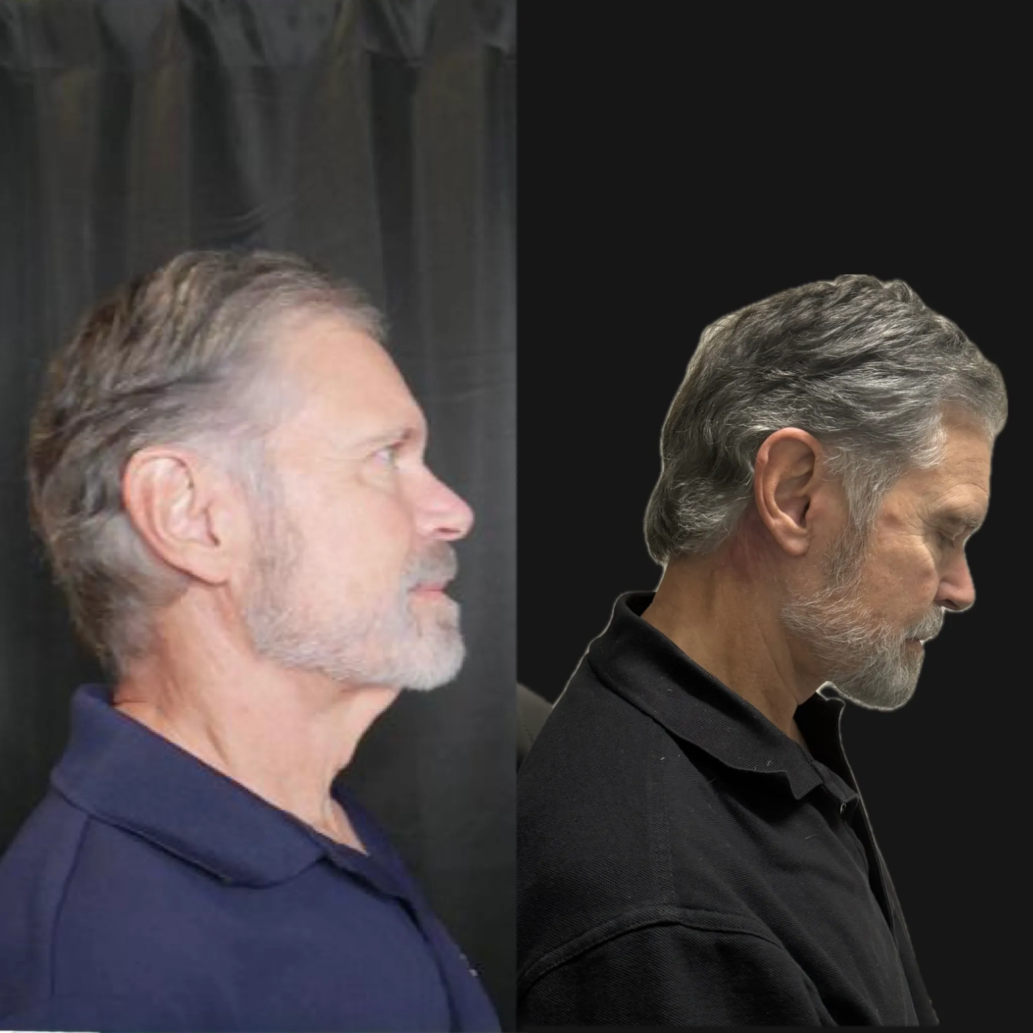 Male Face & Neck Lift, before and after, patient of Dr. Christine Bokman