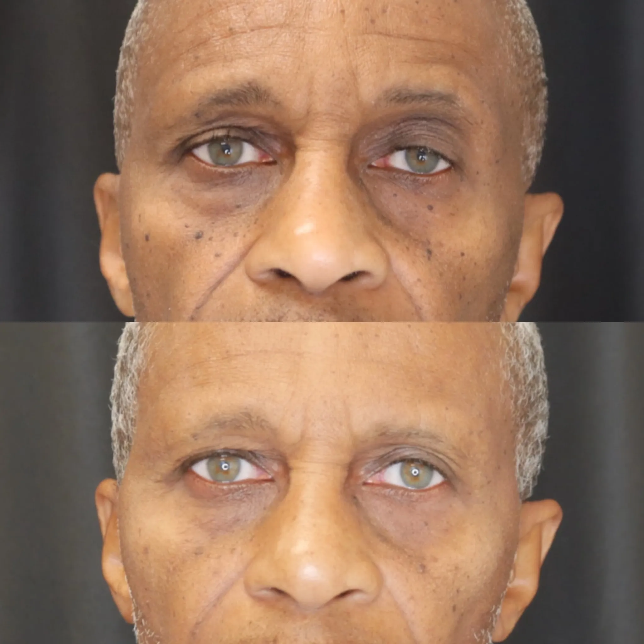 Ptosis Repair, before and after, patient of Dr. Christine Bokman