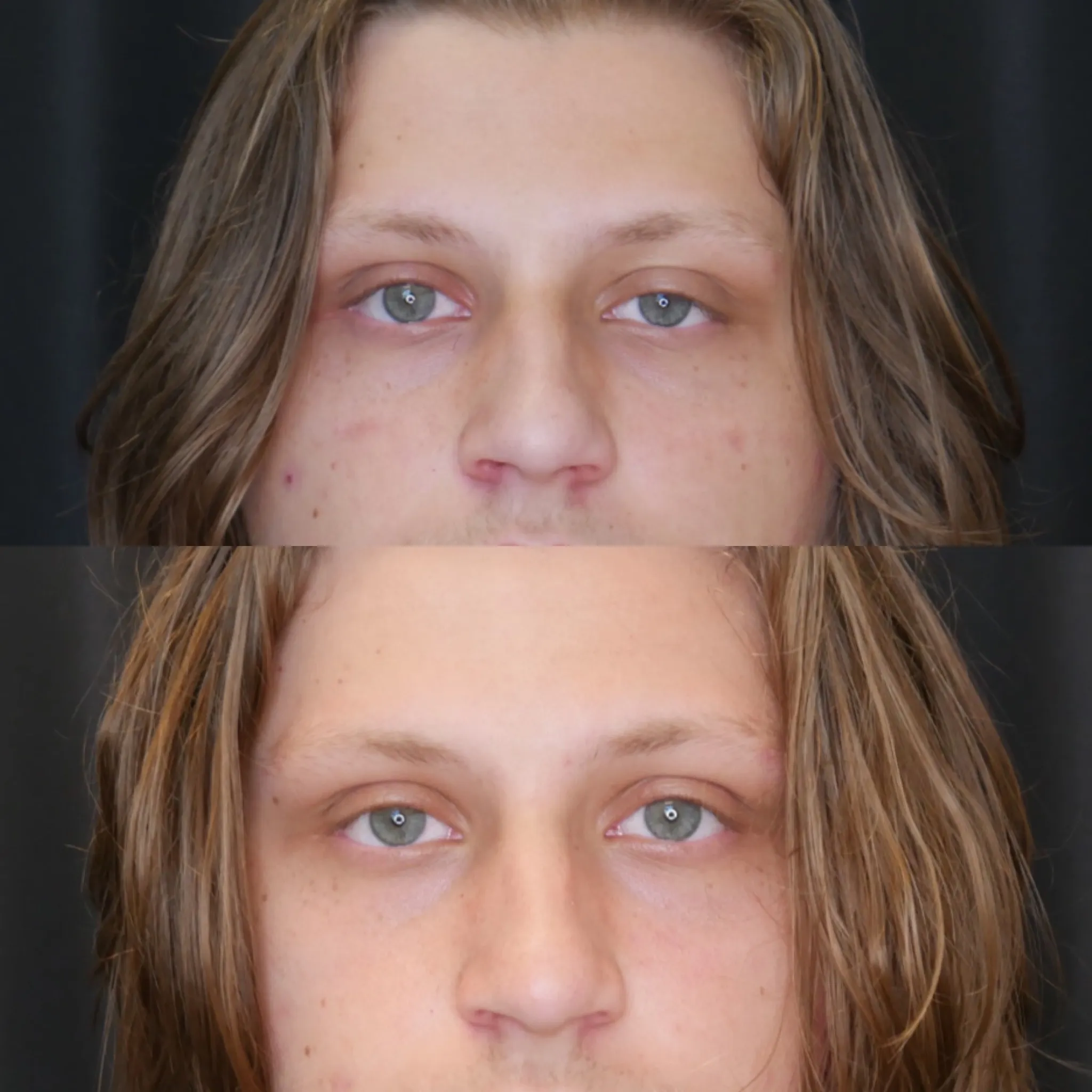 Ptosis Repair, before and after, patient of Dr. Christine Bokman