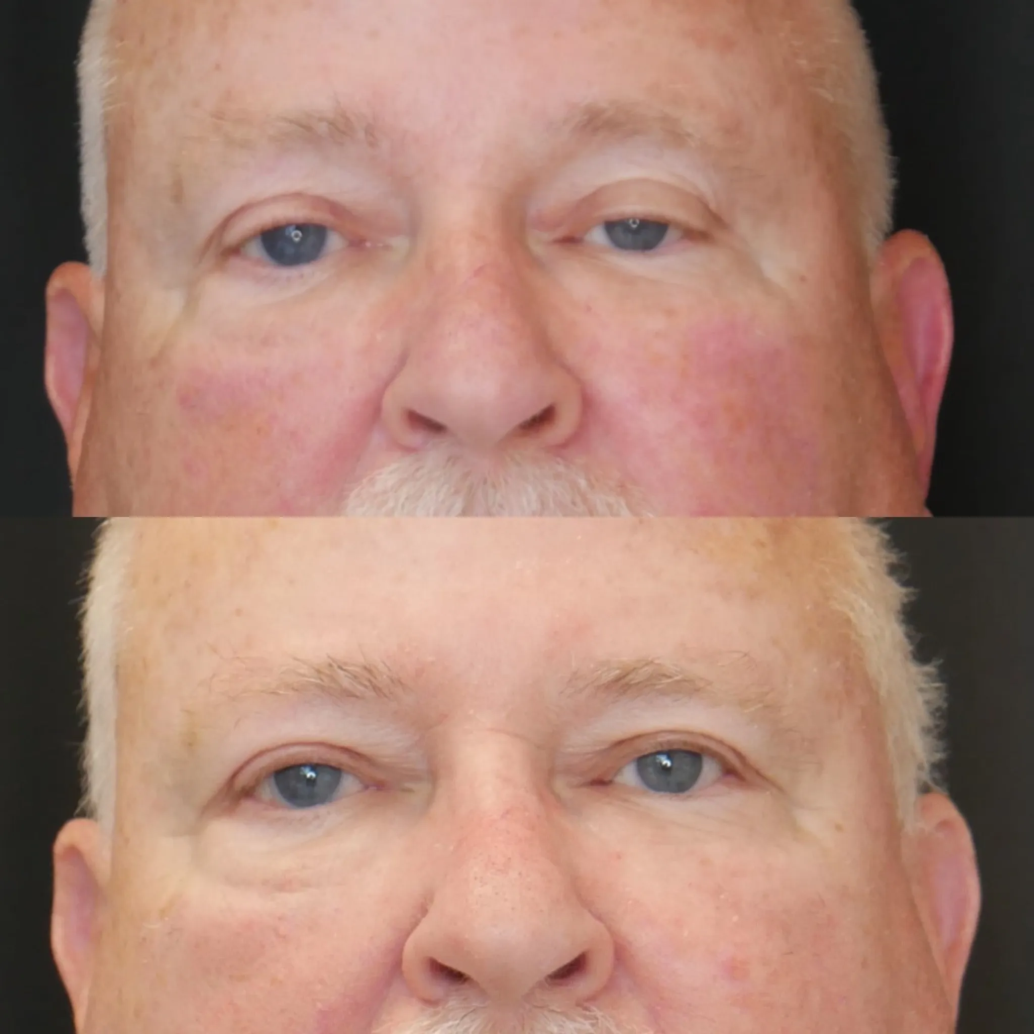 Ptosis Repair, before and after, patient of Dr. Christine Bokman