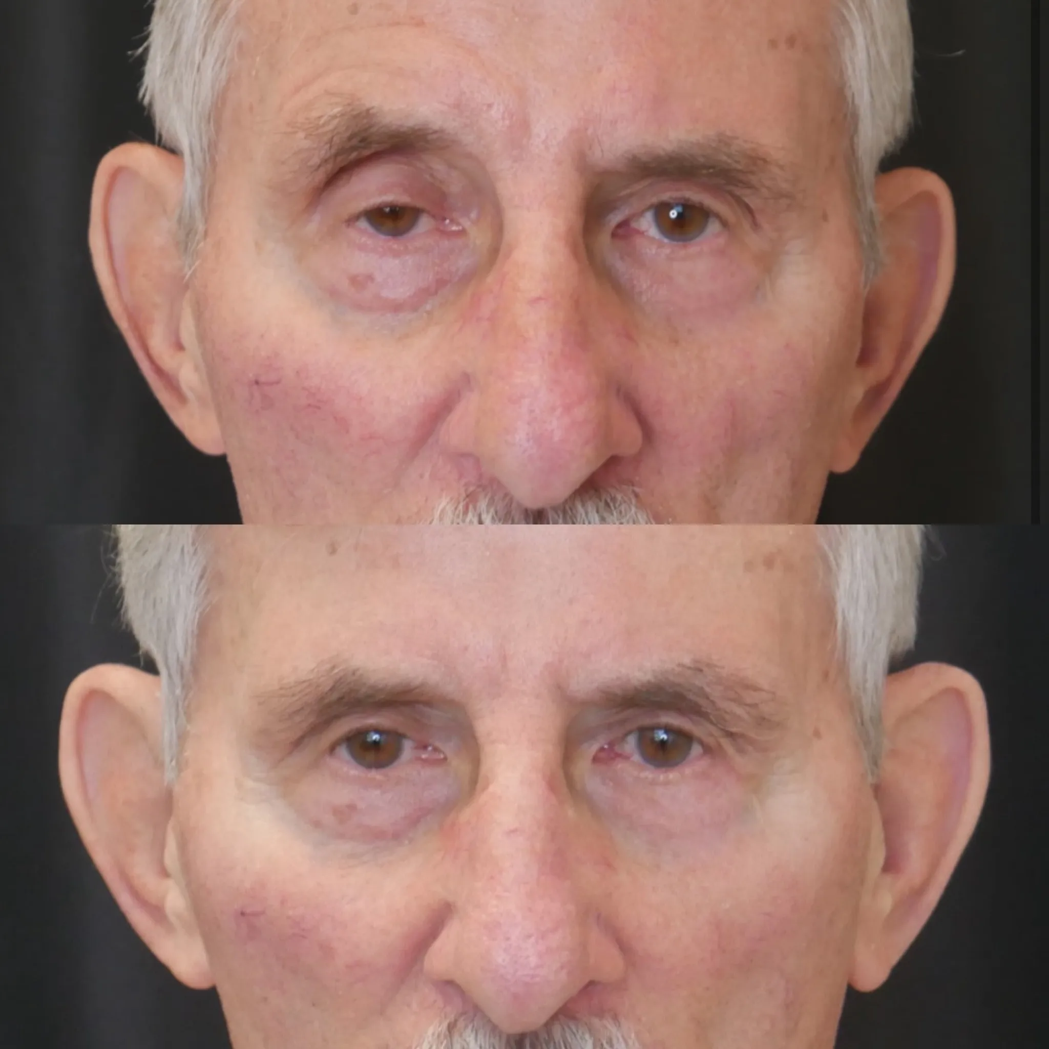 Ptosis Repair, before and after, patient of Dr. Christine Bokman