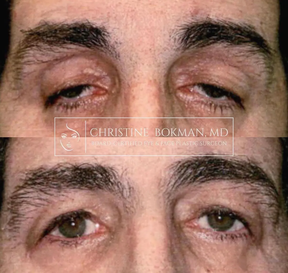 Ptosis Repair, before and after, patient of Dr. Christine Bokman