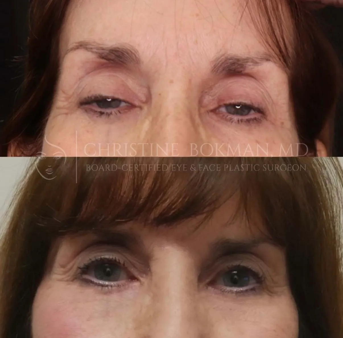 Ptosis Repair, before and after, patient of Dr. Christine Bokman