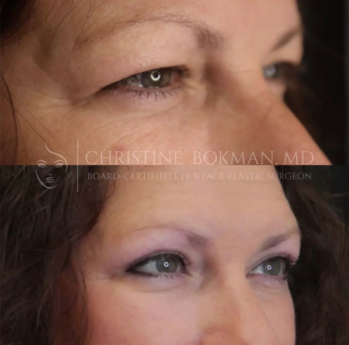 Upper Blepharoplasty, before and after, patient of Dr. Christine Bokman