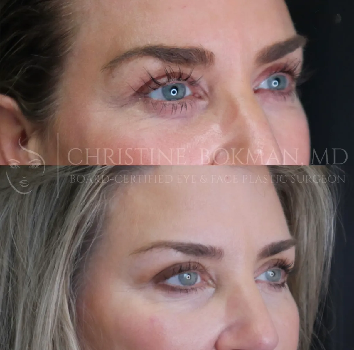 Temporal Brow Lift & Blepharoplasty, before and after, patient of Dr. Christine Bokman