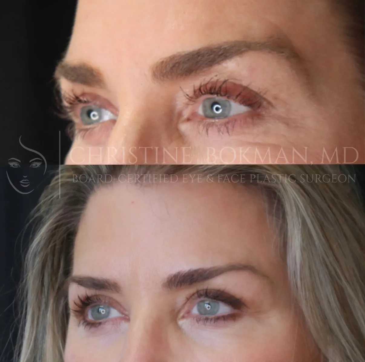 Temporal Brow Lift & Blepharoplasty, before and after, patient of Dr. Christine Bokman