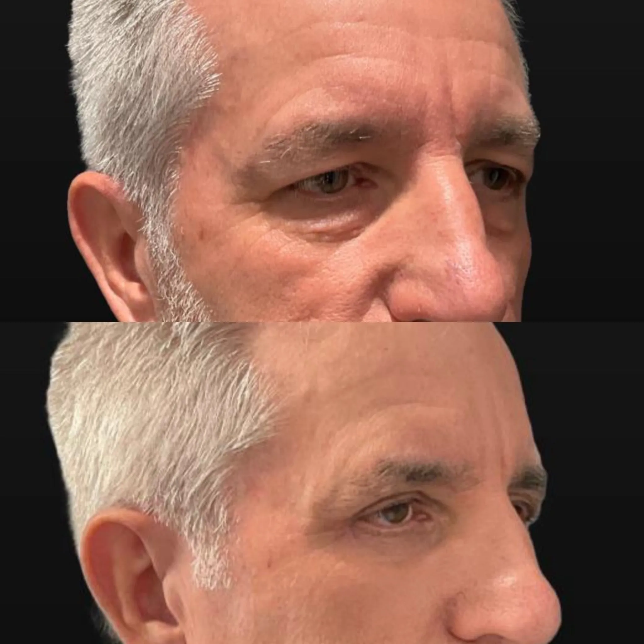 Upper & Lower Blepharoplasty, before and after, patient of Dr. Christine Bokman