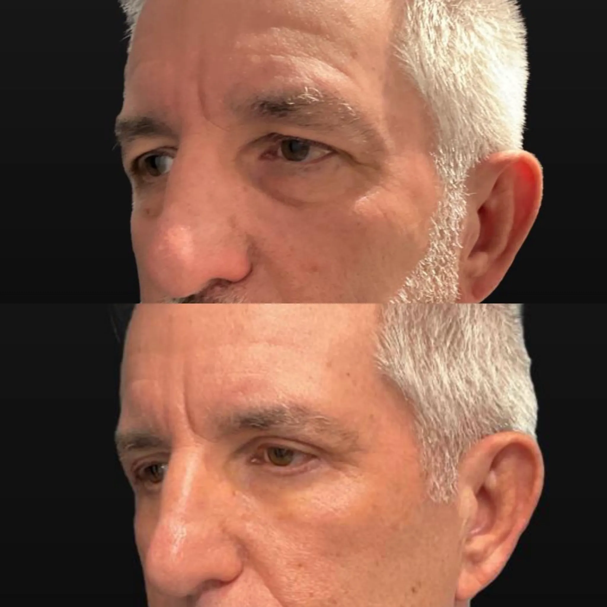 Upper & Lower Blepharoplasty, before and after, patient of Dr. Christine Bokman