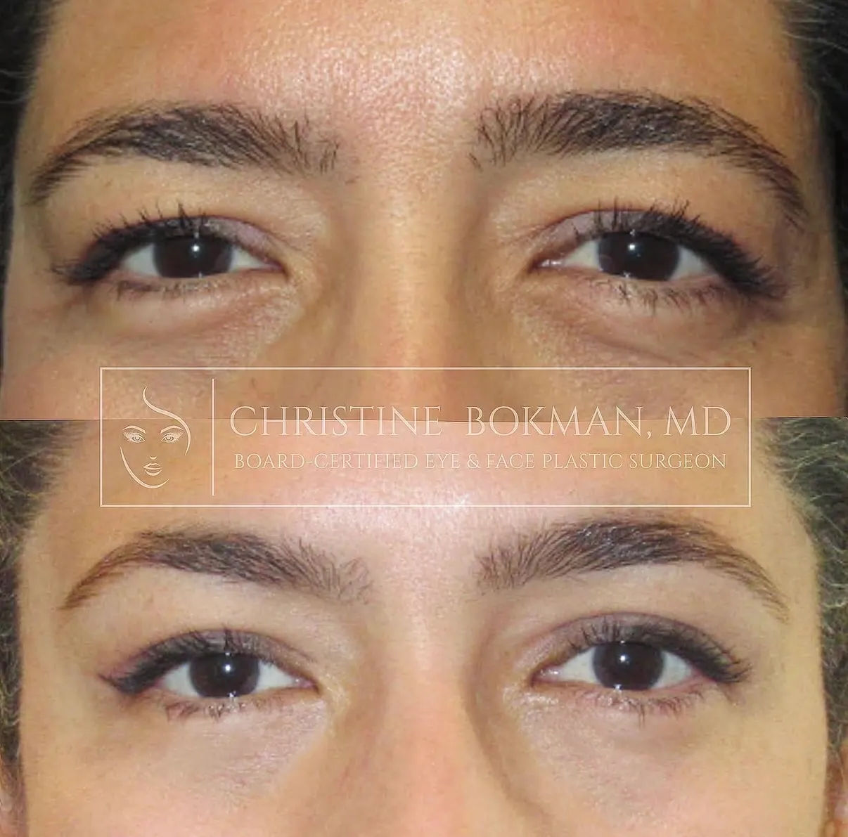 Upper & Lower Blepharoplasty, before and after, patient of Dr. Christine Bokman