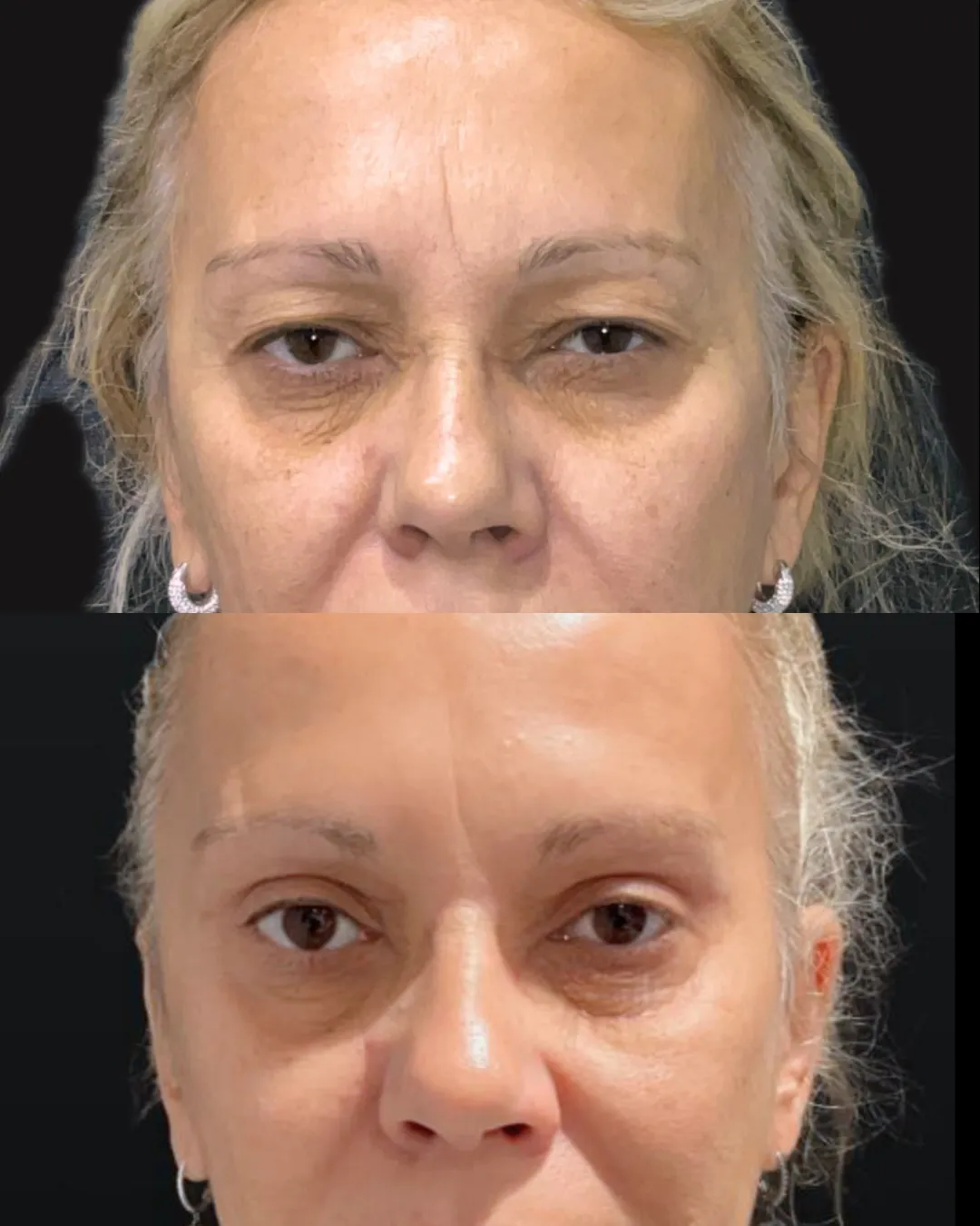 Upper Blepharoplasty, before and after, patient of Dr. Christine Bokman