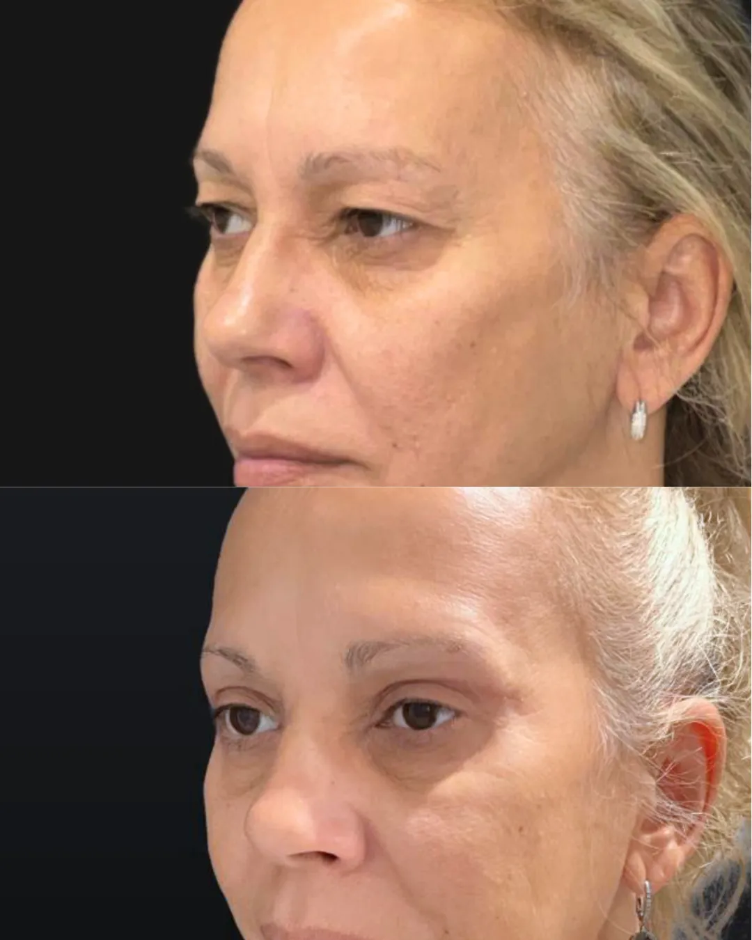 Upper Blepharoplasty, before and after, patient of Dr. Christine Bokman