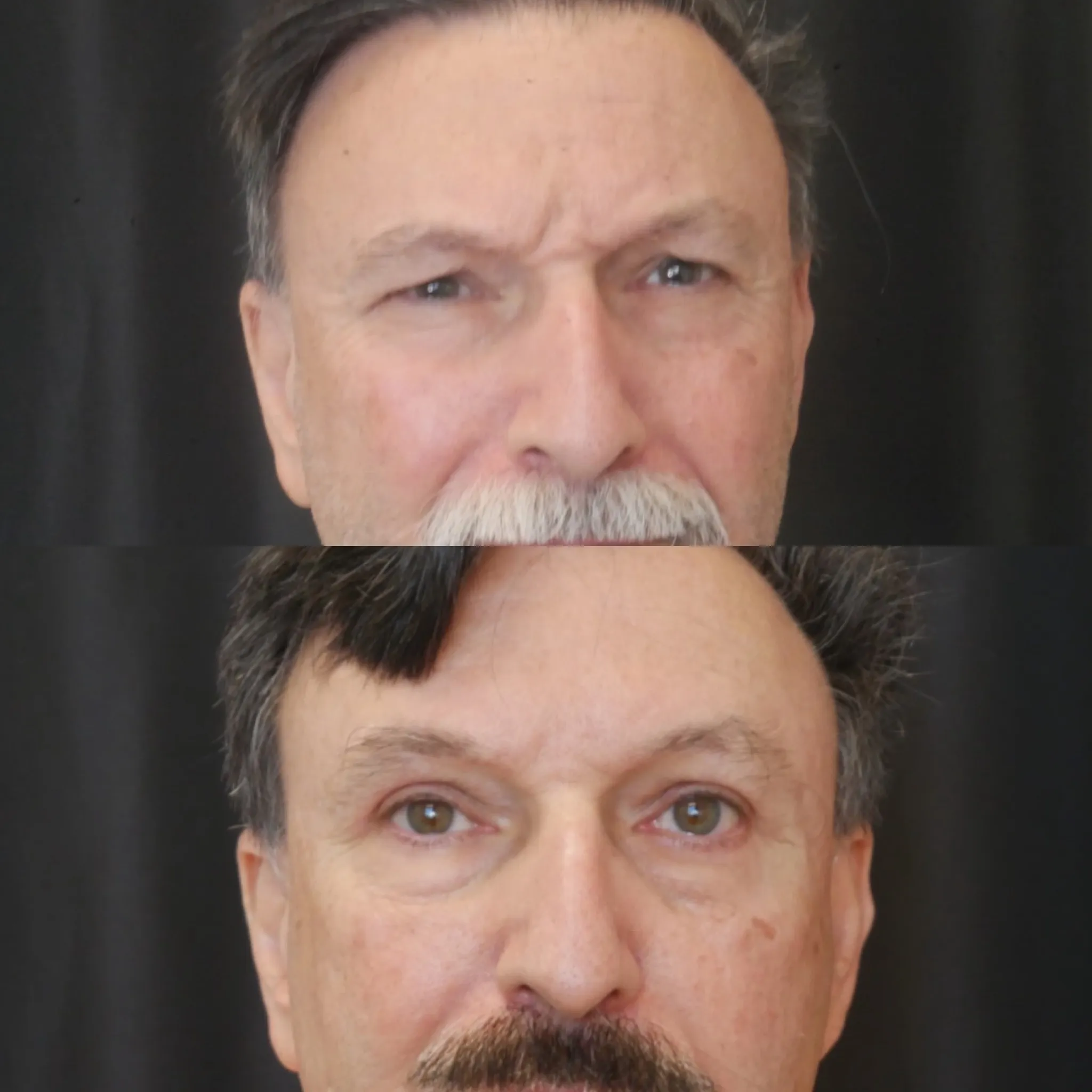 Upper Blepharoplasty, before and after, patient of Dr. Christine Bokman