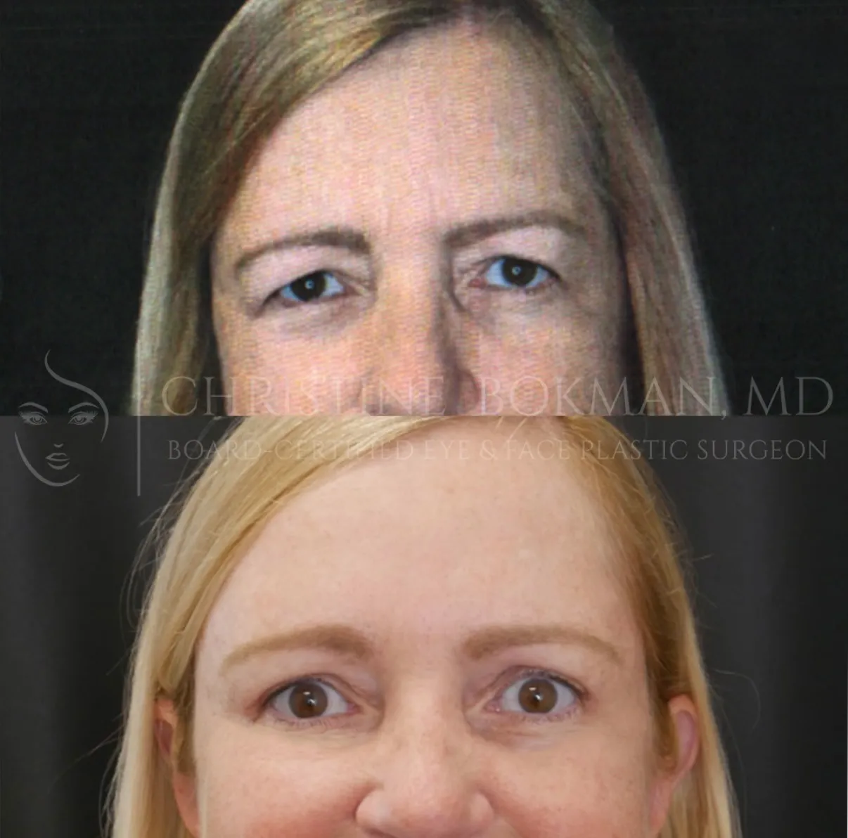 Upper Blepharoplasty, before and after, patient of Dr. Christine Bokman