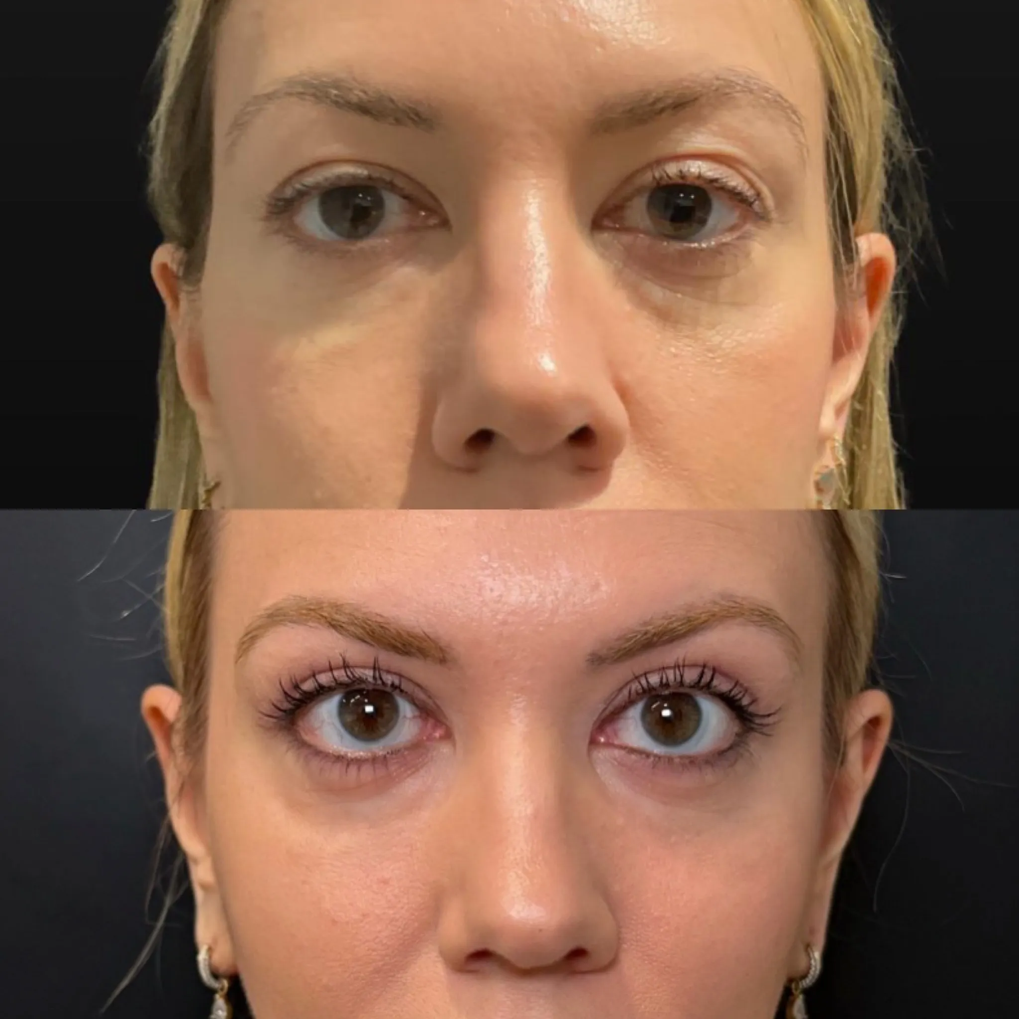 Upper Blepharoplasty, before and after, patient of Dr. Christine Bokman