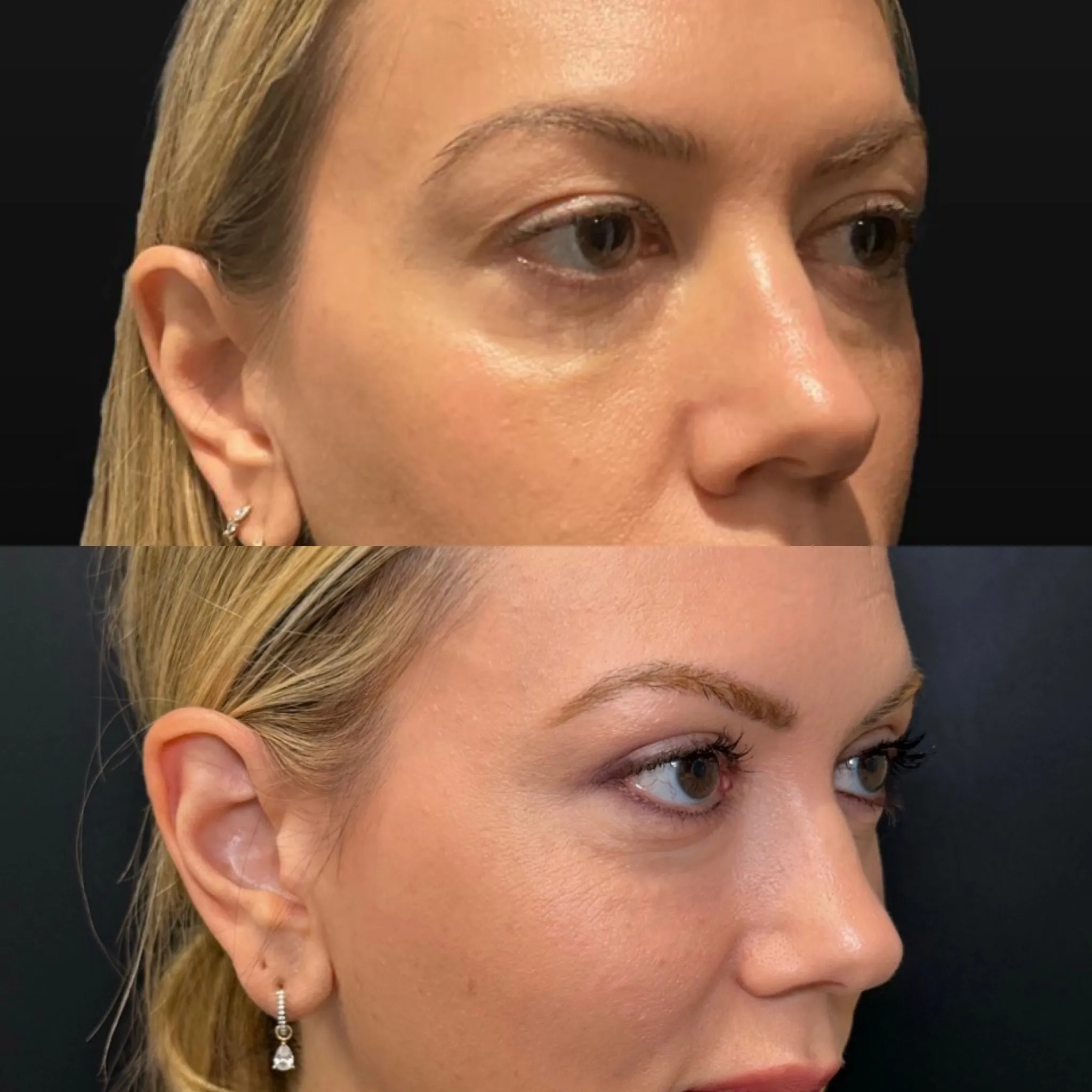 Upper Blepharoplasty, before and after, patient of Dr. Christine Bokman