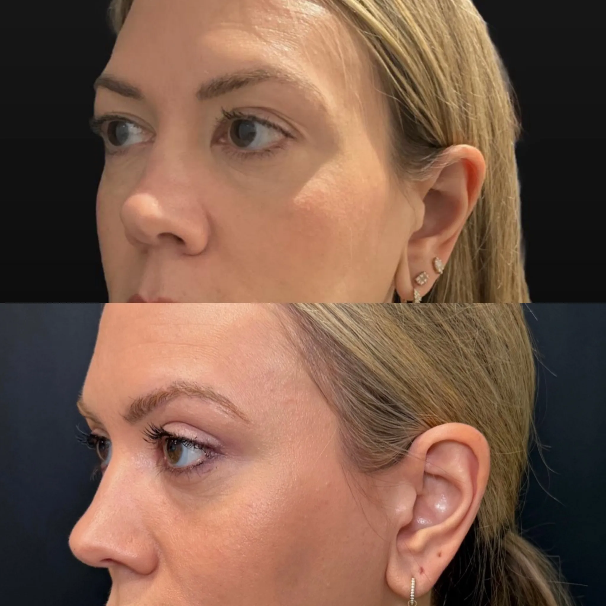 Upper Blepharoplasty, before and after, patient of Dr. Christine Bokman