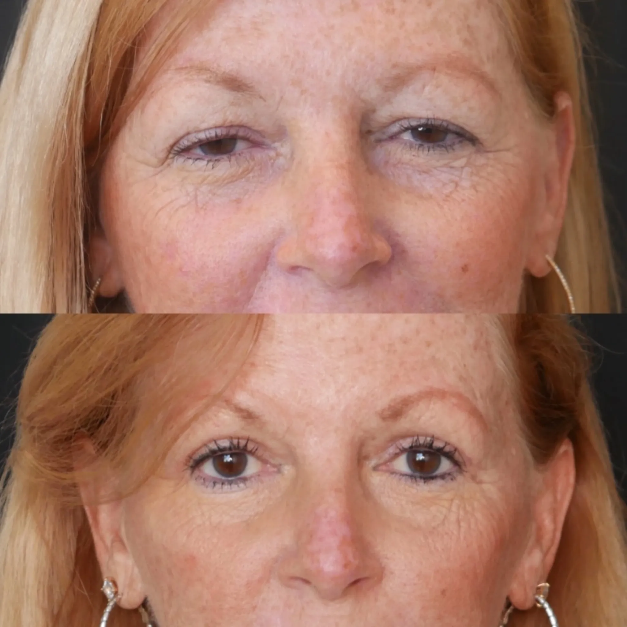 Upper Blepharoplasty, before and after, patient of Dr. Christine Bokman