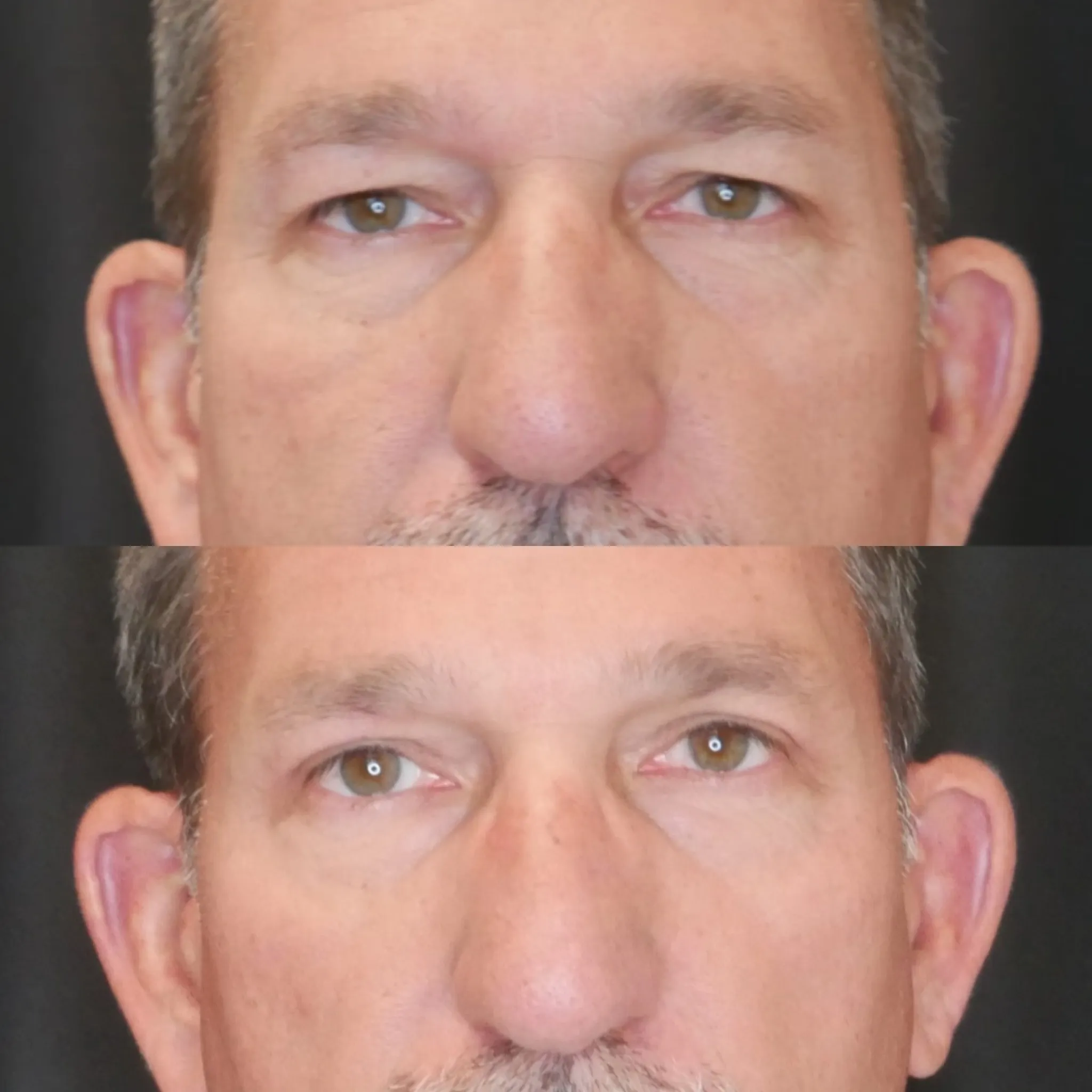 Upper Blepharoplasty, before and after, patient of Dr. Christine Bokman