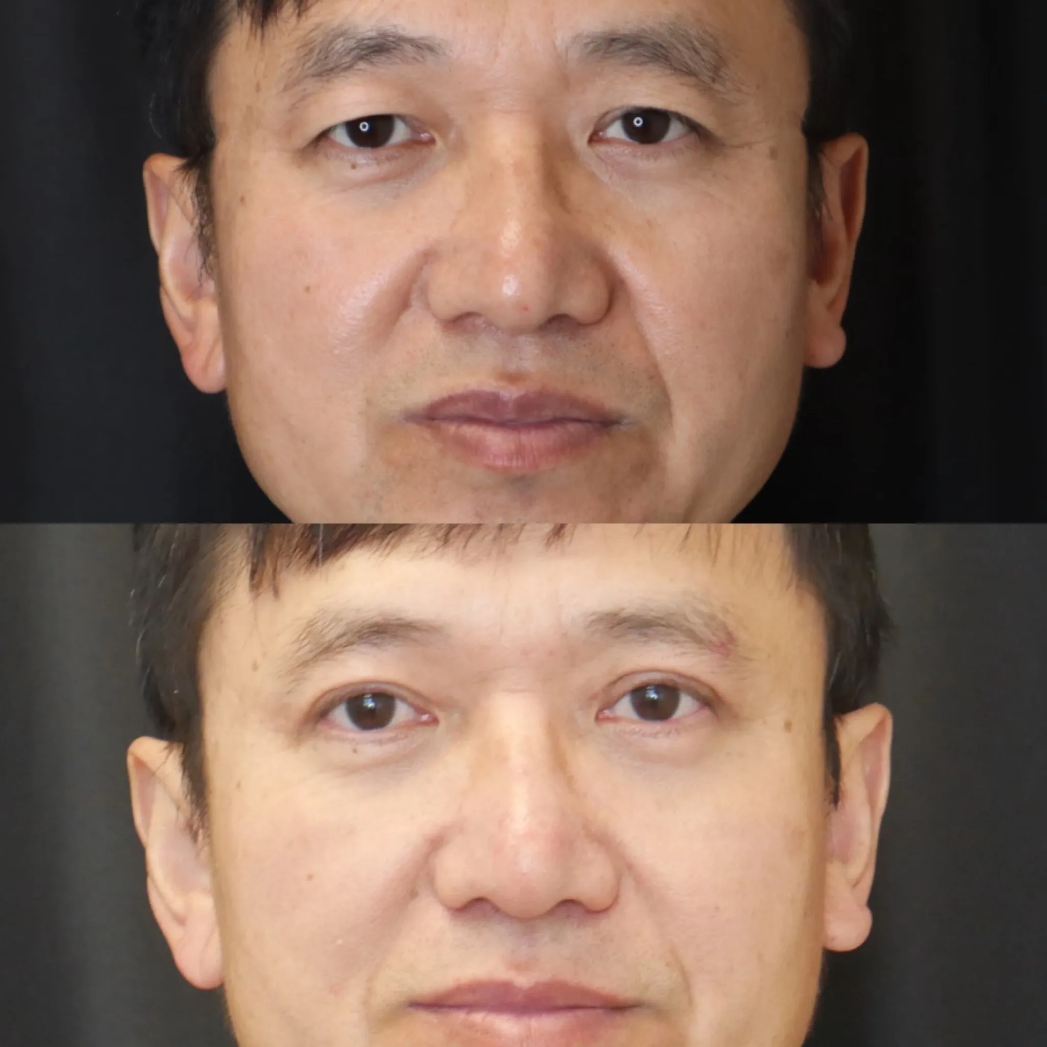 Upper Blepharoplasty, before and after, patient of Dr. Christine Bokman